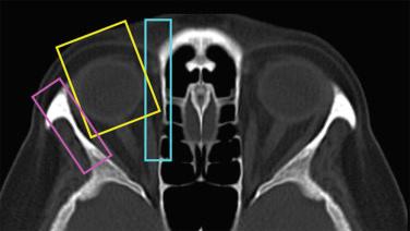 Figure 36.2, Transorbital approaches are divided in anterior (yellow), medial (blue) and lateral (pink).