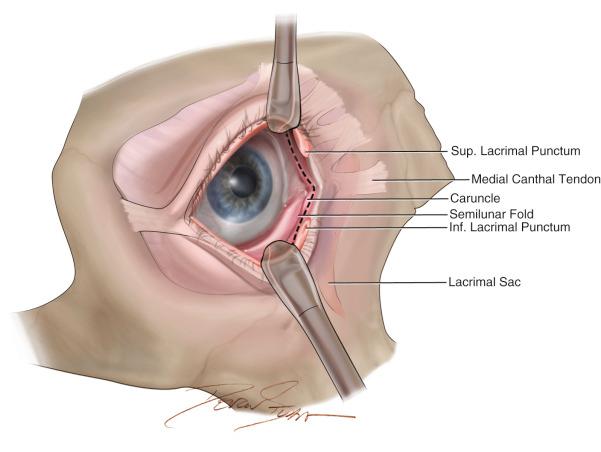Figure 36.5, Medial aspect of the right eye demonstrating the precaruncular incision. The incision will be placed in between the caruncle and semilunar fold. The incision is extended at least to the level of the upper and lower lacrimal punctum. The canalicular system is protected with a probe.
