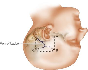 Figure 35.3, The usual location for the burr holes for the subtemporal craniotomy (A) in the squamosal temporal bone at the zygomatic root, (B) superior temporal line, (C) asterion (at the level of the middle fossa) and (D) superiorly (behind the area of insertion of the vein of Labbé into the transverse sinus).