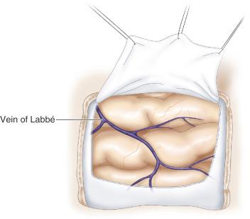 Figure 35.4, U-shaped dural incision, with the base at the skull base. The vein of Labbé is shown after dural flap elevation.
