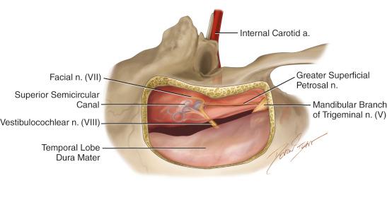 Figure 35.5, The petrous bone can be drilled along the line that bisects the angle formed by the long axis of the arcuate eminence and the greater superficial petrosal nerve, exposing the internal acoustic canal.