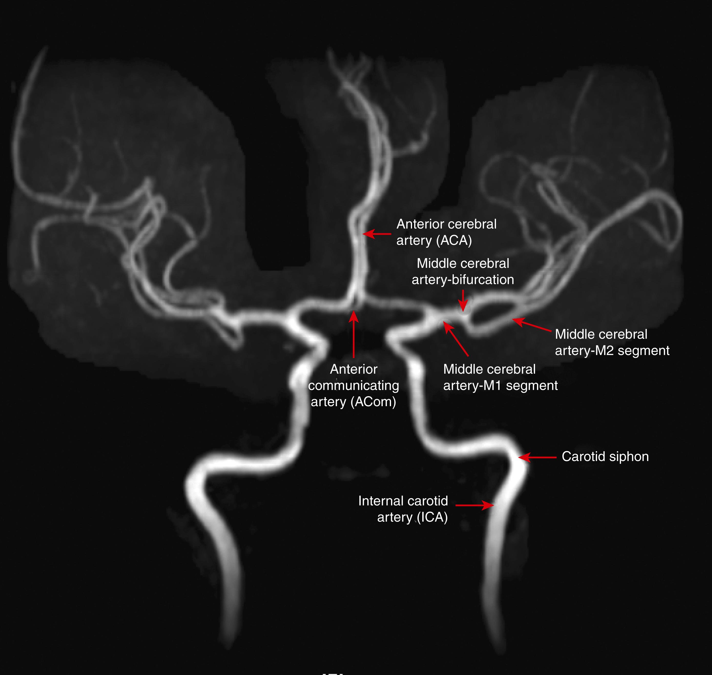 FIGURE 375-2, Magnetic resonance angiogram of the intracranial portion of the internal carotid artery and its main branches.