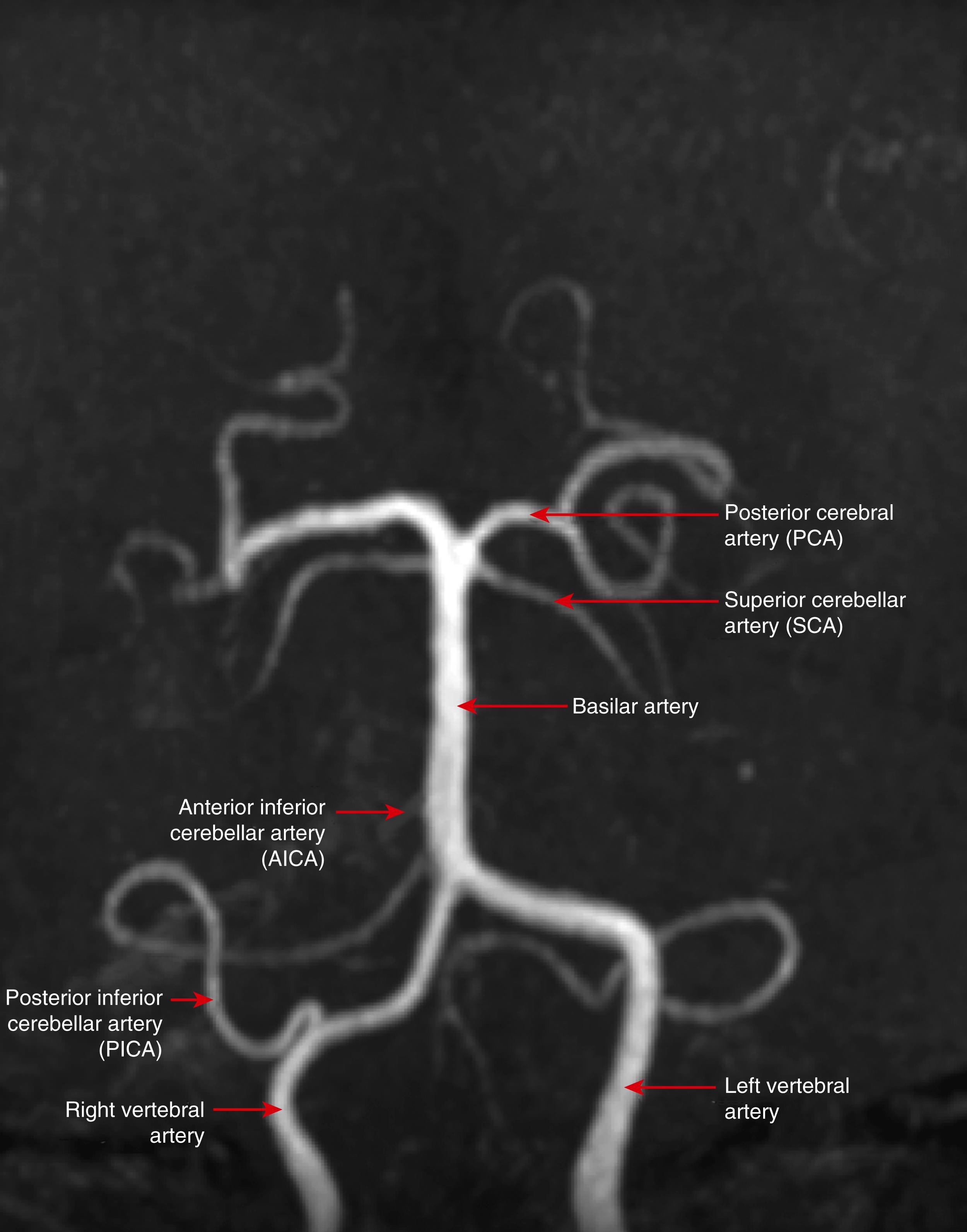 FIGURE 375-3, Magnetic resonance angiogram of the intracranial portion of the vertebrobasilar system.