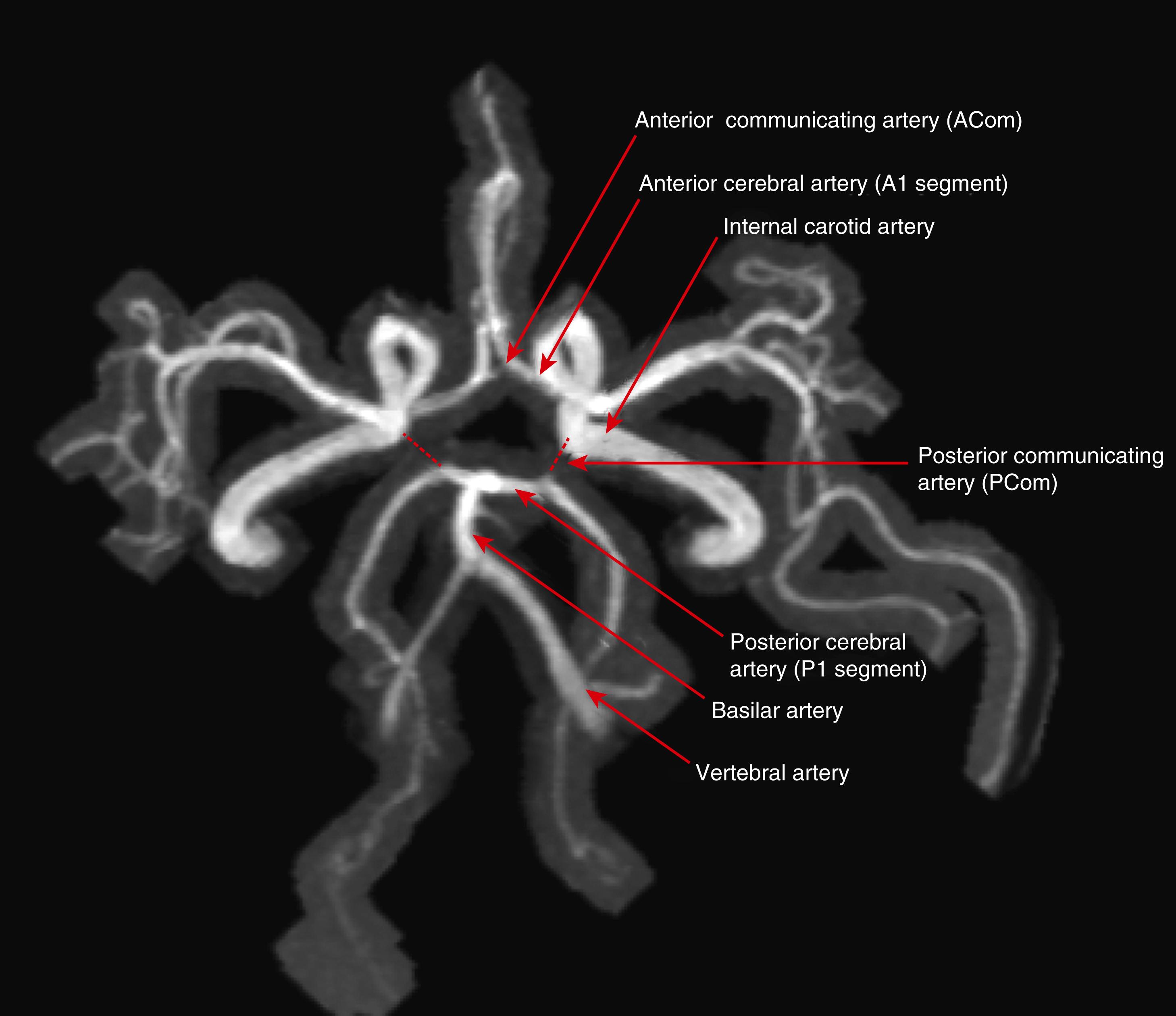 E-FIGURE 375-1, Magnetic resonance angiogram of the circle of Willis.