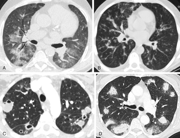 FIGURE 17.7, Distribution of disease in four separate patients: central versus peripheral. A, A 1.25-mm axial section in the upper lobes demonstrates central ground-glass opacities representing pulmonary edema in this patient with cardiac failure awaiting heart transplant. B, Axial sections in a patient with Kaposi sarcoma show central peribronchovascular nodules and flame-shaped opacities. C, Axial section in a patient with septic emboli secondary to endocarditis of the tricuspid valve shows multiple solid and cavitary peripheral nodules of variable size. D, Axial image through the mid zone in this patient with organizing pneumonia demonstrates multiple peripheral and peribronchiolar consolidative opacities with air bronchograms. This appearance is typical of organizing pneumonia.