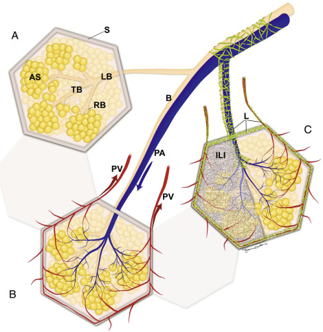 FIGURE 17.8, Diagram depicting the anatomy of the secondary pulmonary lobule (SPL). A, Airways. An SPL is surrounded by interlobular septa (S). Within the SPL, a lobular bronchiole (LB) divides into several terminal bronchioles (TBs) that in turn divide into multiple respiratory bronchioles (RBs). Several alveolar sacs (ASs) communicate with the RBs. This is the site of gaseous exchange within the lungs. B, Lobular pulmonary vessels. The pulmonary artery (PA in blue ) branches course into the SPL alongside the bronchioles. The PA carries deoxygenated blood into the SPL and divides into a rich capillary network that surrounds the alveolar sacs. The capillary network transfers oxygenated blood to the periphery of the SPL. Pulmonary veins (PV in red ) lie within the interlobular septa and transmit blood back to the heart. C, Interstitium. The lymphatics (L in green ) course within a sheath that surrounds the bronchovascular bundle and course within the interlobular septa together with the pulmonary veins. There is an internal framework of connective tissue within the SPL that surrounds the alveolar sacs, known as the intralobular interstitium (ILI in gray ).