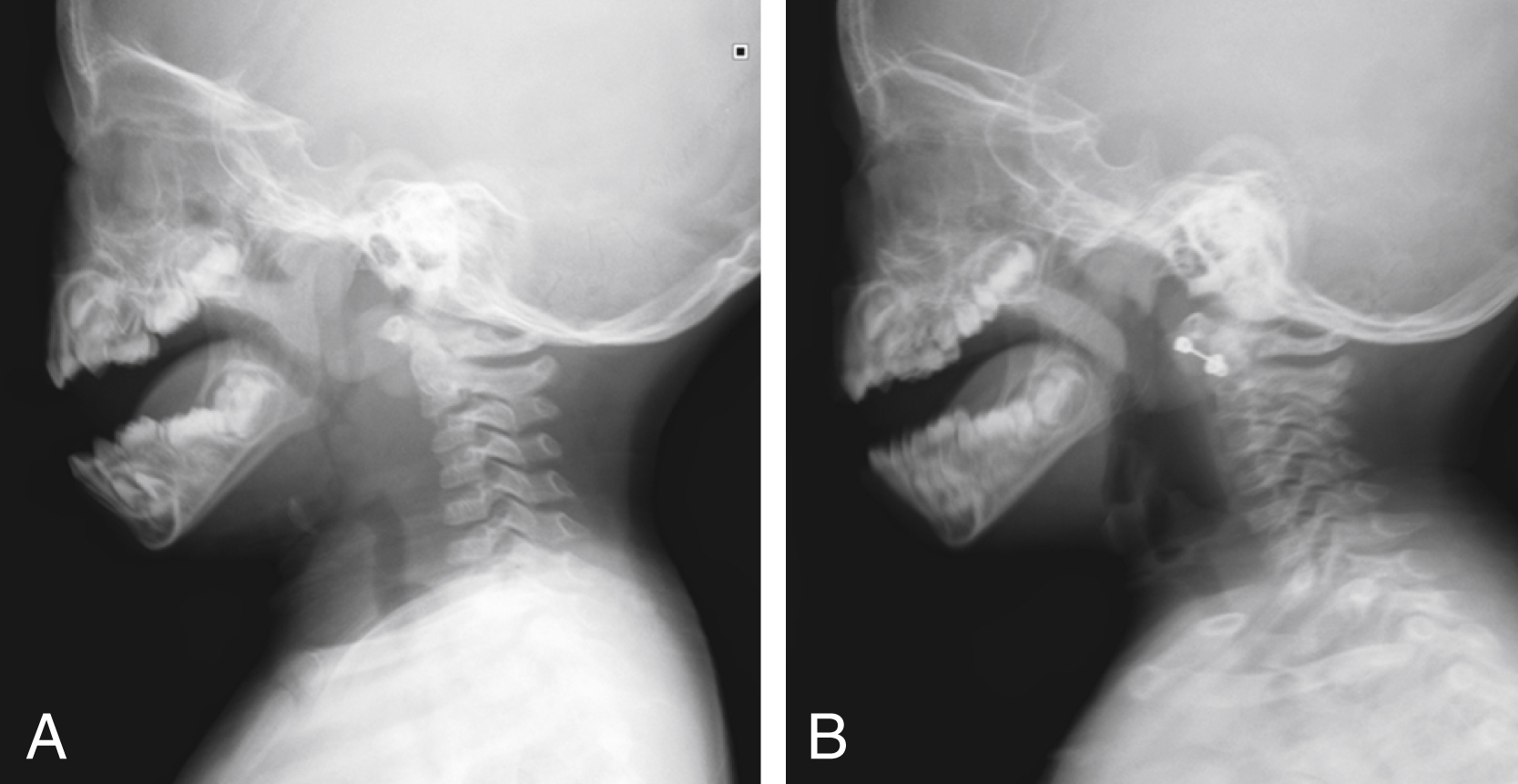 Fig. 26.1, Lateral radiographs of the neck taken minutes apart in a 2-year-old obtained in (A) expiration and slight flexion demonstrates thickened prevertebral soft tissues. Image obtained during inspiration in slight extension (B) shows resolution of prevertebral soft tissue thickening as a result of technical factors and patient’s oropharyngeal phase.