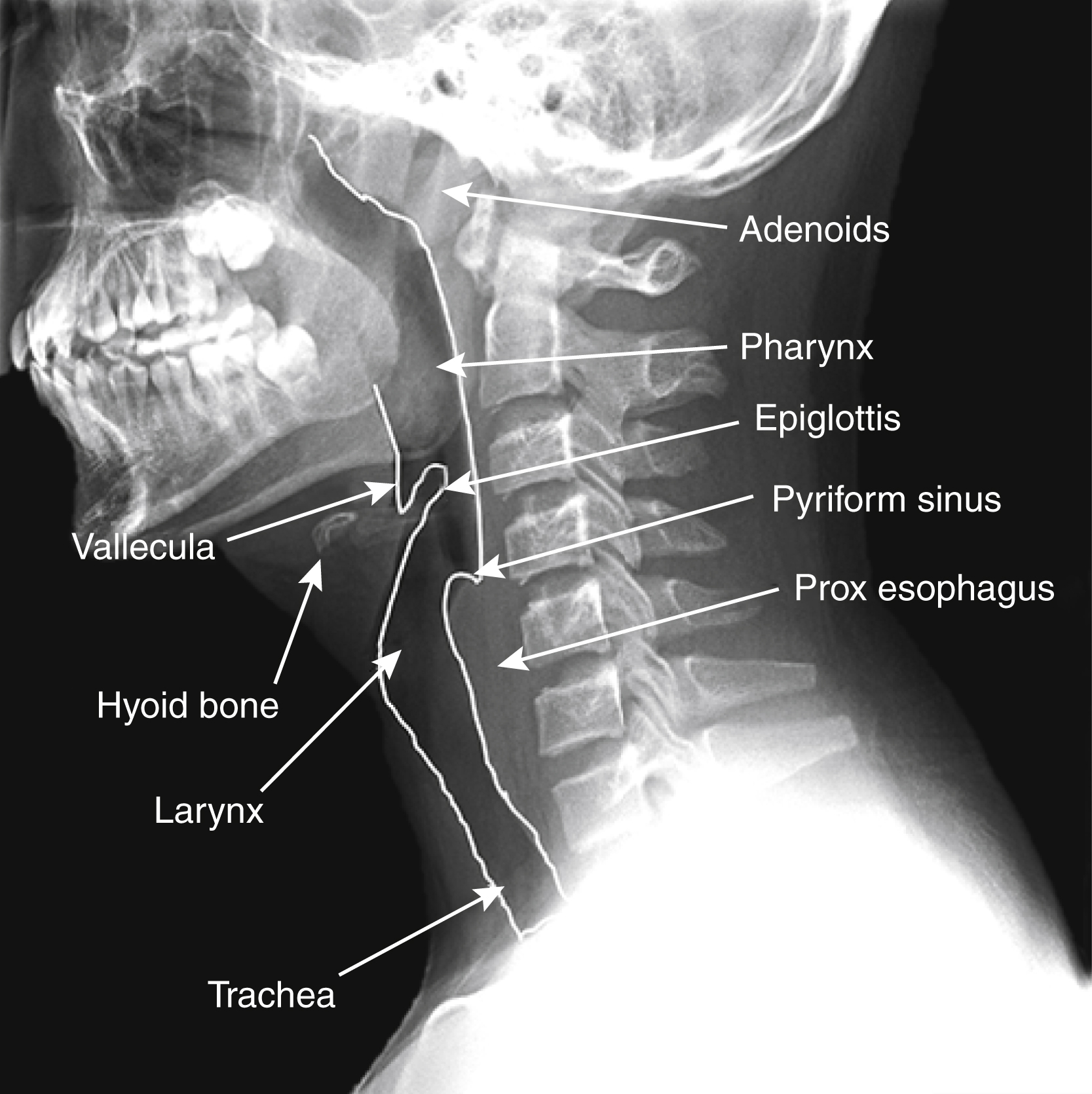 Fig. 26.2, Normal neck anatomy.