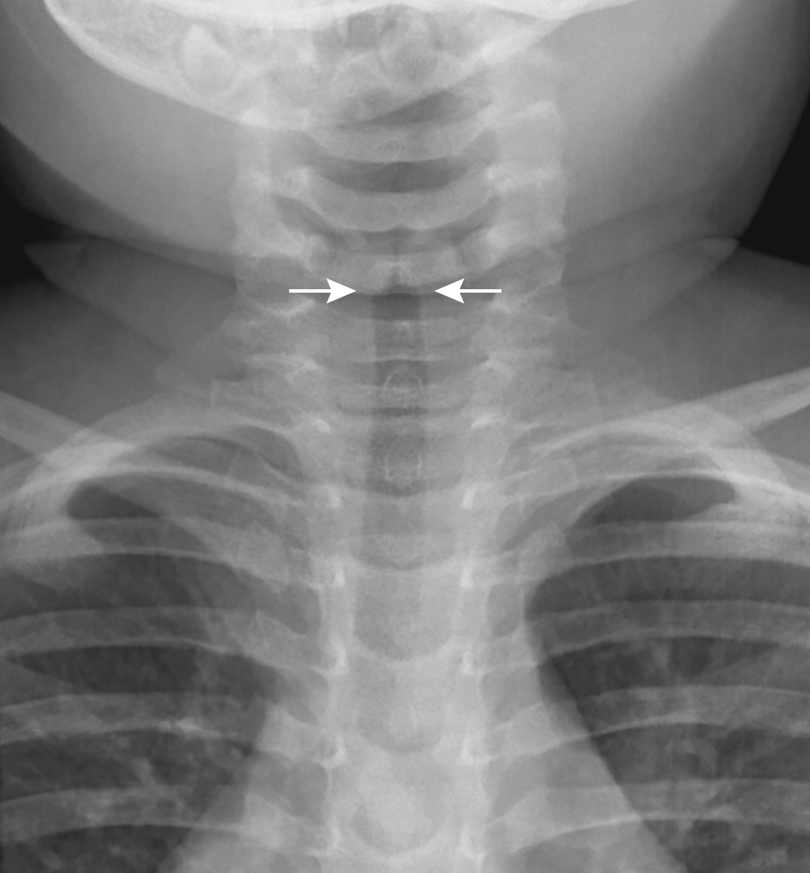 Fig. 26.3, Normal shouldering of the subglottic airway on a frontal view. Note the near-horizontal orientation of the superior margin of the subglottic tracheal column ( arrows ).