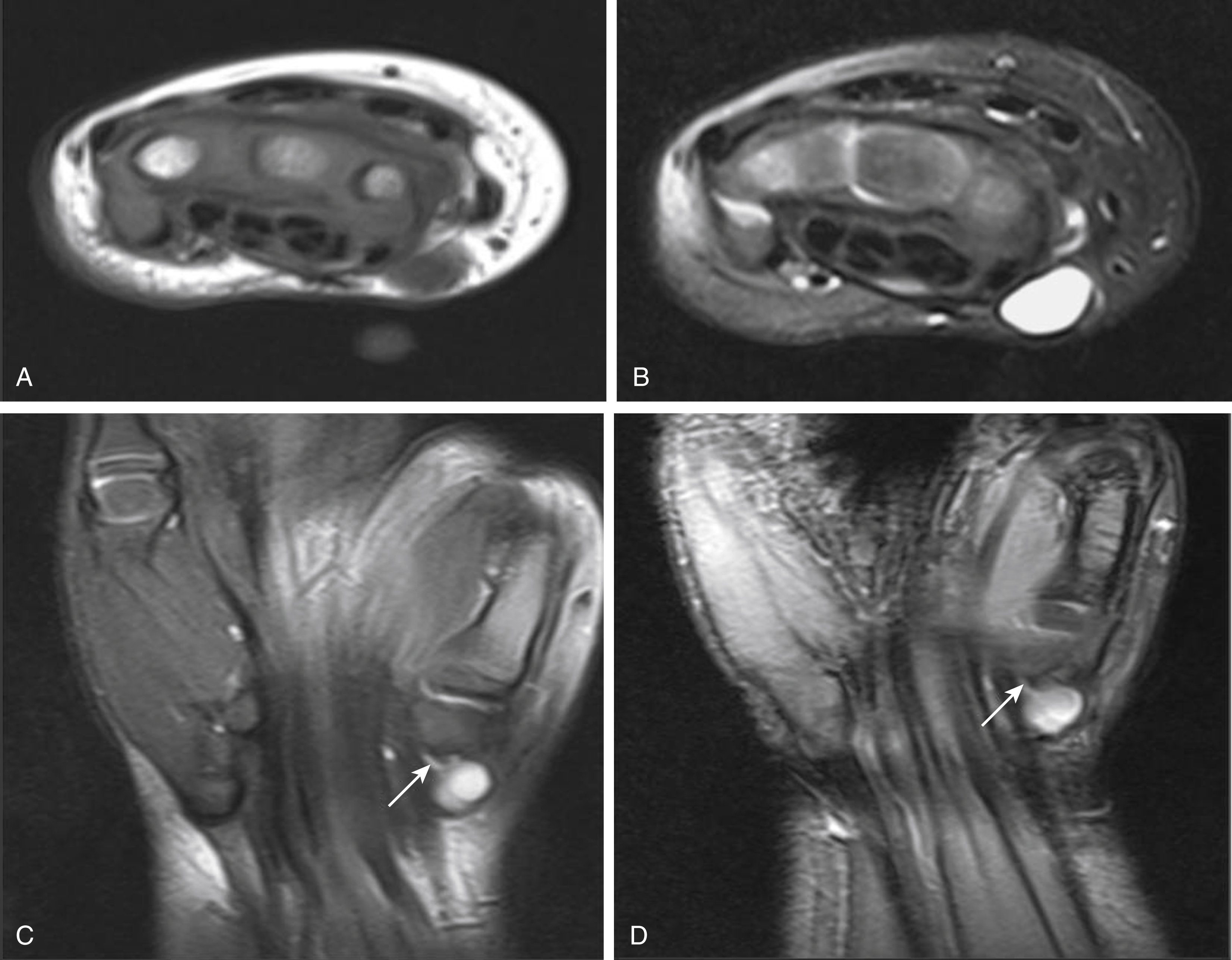 Fig. 16.1, Five-year-old with palpable lump of the wrist with magnetic resonance imaging T1- (A) and T2-weighted (B) axial images and coronal T2-weighted (C) and proton density (D) sequences showing a cystic structure adjacent to the volar midcarpal row with a thin tail ( arrow ) consistent with a ganglion cyst.