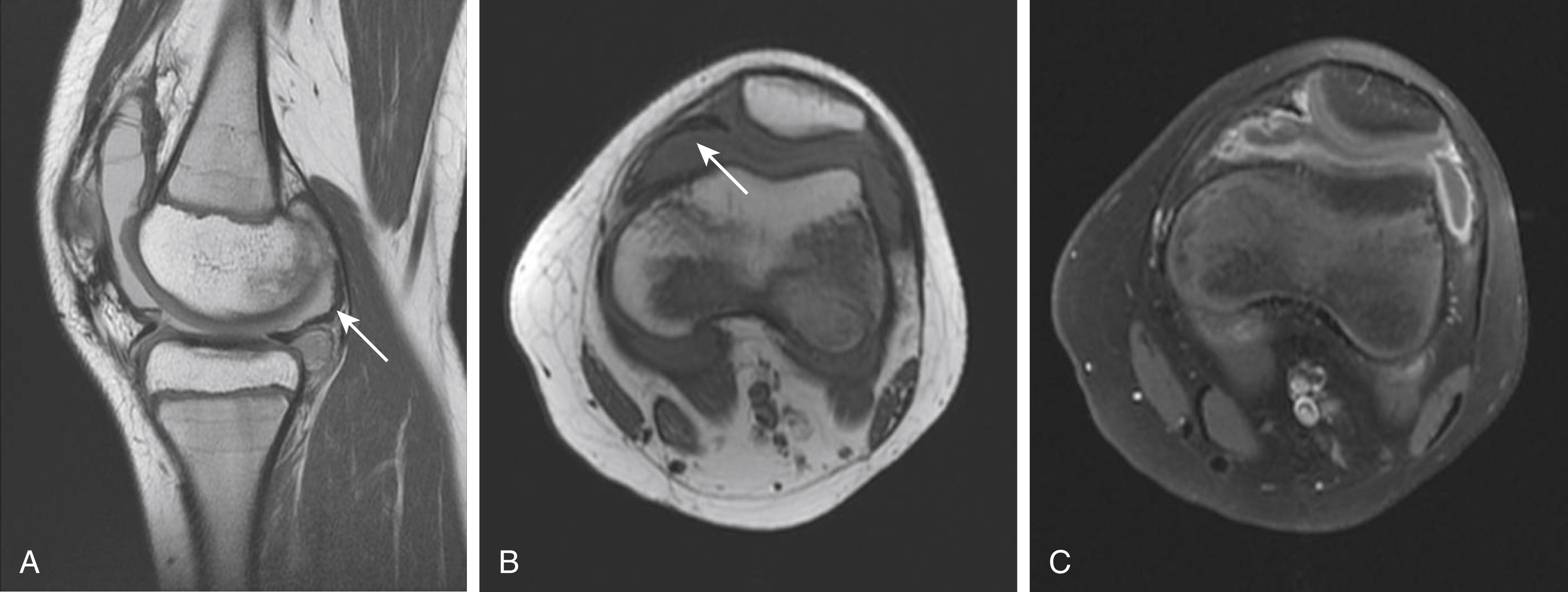 Fig. 16.3, Ten-year-old with history of knee swelling and pain with sagittal proton density sequence (A) and axial T1-weighted sequence (B) demonstrating hypointense signal of synovium and the Hoffa fat pad ( arrows ), with axial postcontrast fat-saturated image (C) demonstrating enhancing thickened synovium consistent with pigmented villonodular synovitis.