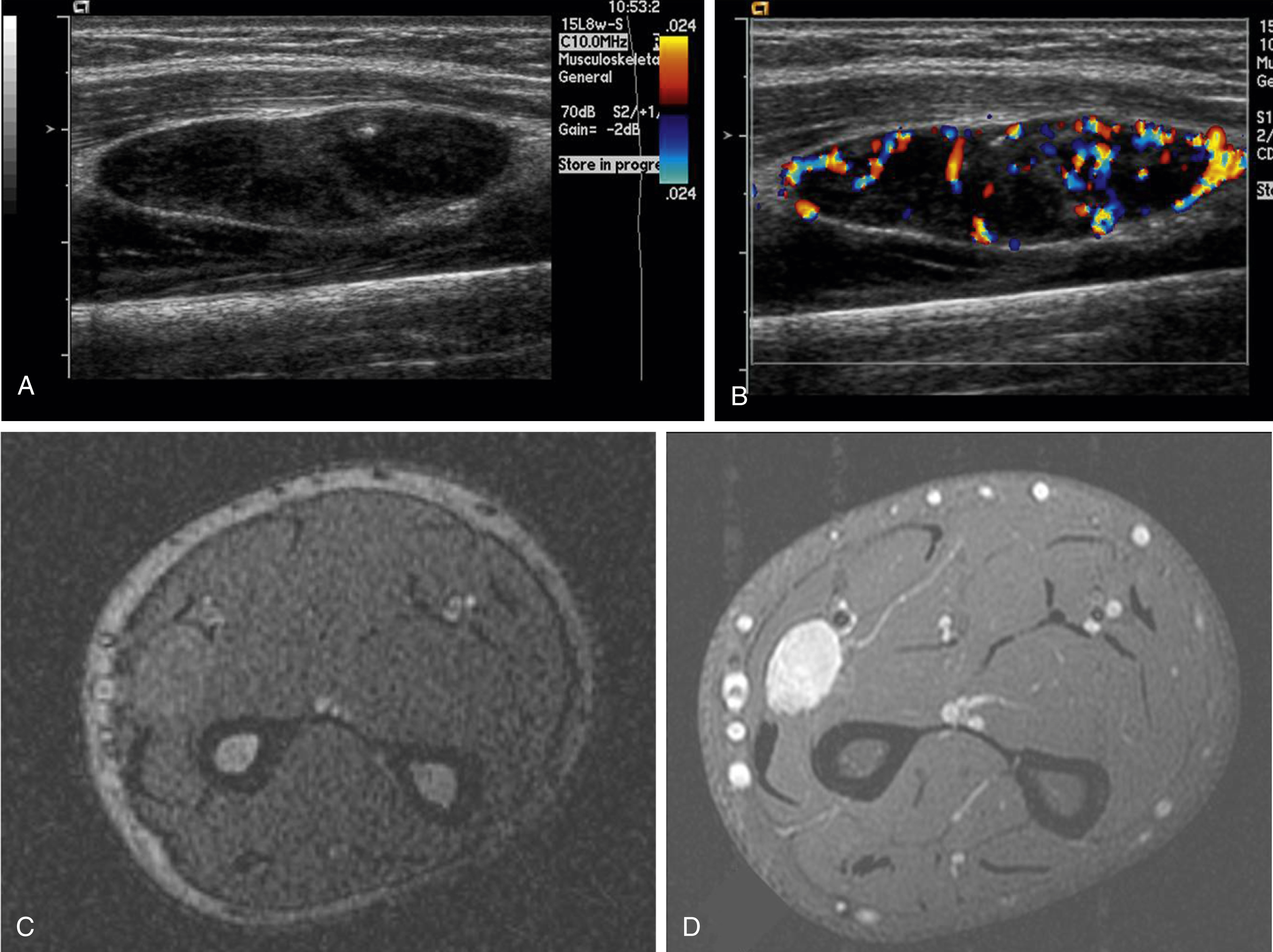 Fig. 16.4, Sixteen-year-old with growing left forearm intramuscular mass who on ultrasound has a well-circumscribed hypoechoic mass (A), which is hypervascular on color Doppler imaging (B) and axial gradient echo sequence demonstrates isointense signal to muscle (C) and postgadolinium T1-weighted fat-saturated sequence demonstrates homogeneous enhancement (D). Biopsy showed synovial sarcoma.