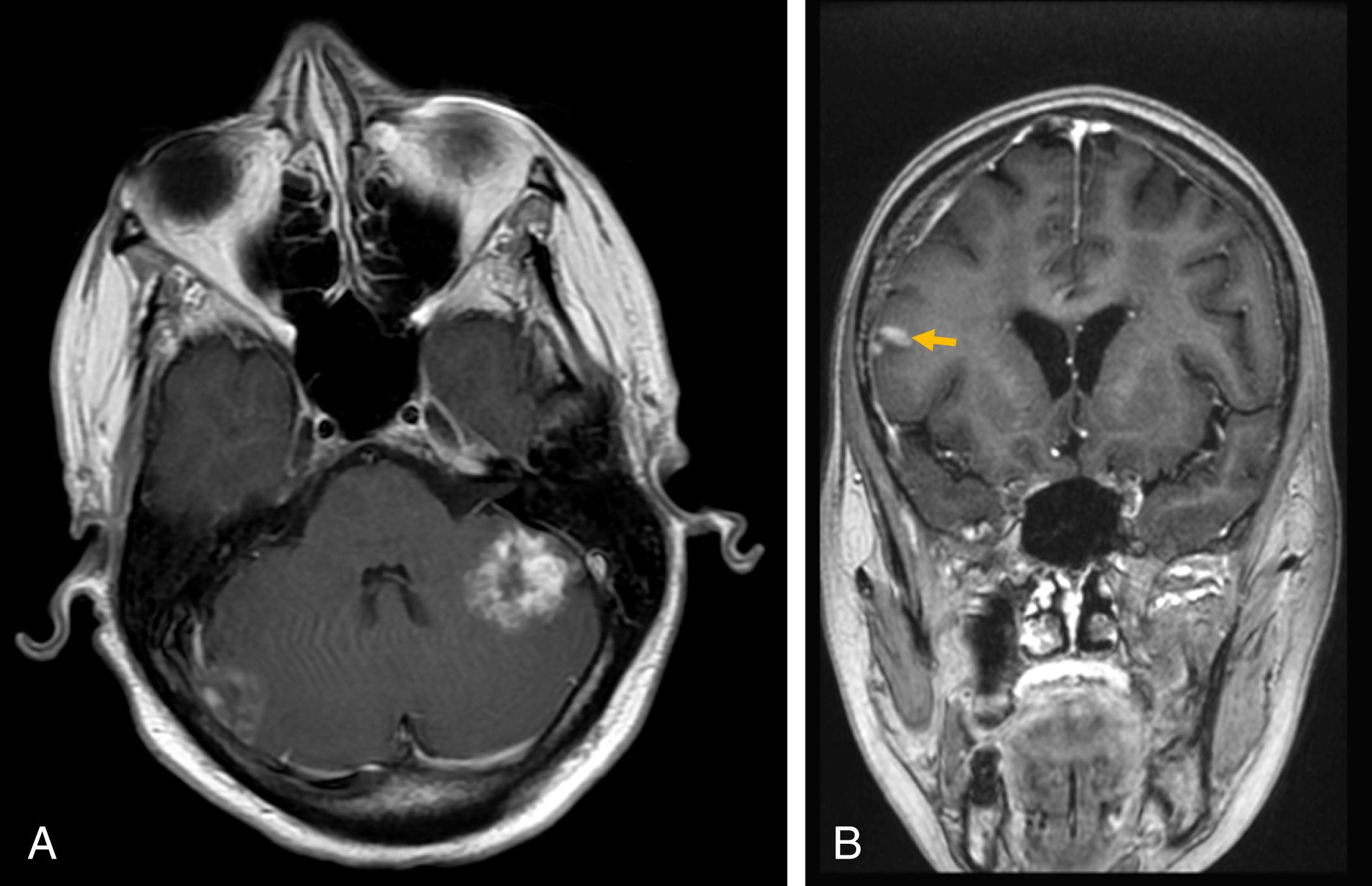 Fig. 14.2, MRI Brain of the patient in Case 14.1 including (A) axial and (B) coronal T1-weighted gadolinium enhanced MRI sequences with a large, enhancing lesion in the left cerebellum and small enhancing lesion in the right cerebellar folia (A) and a small lesion in the right frontal lobe (B, orange arrow ).