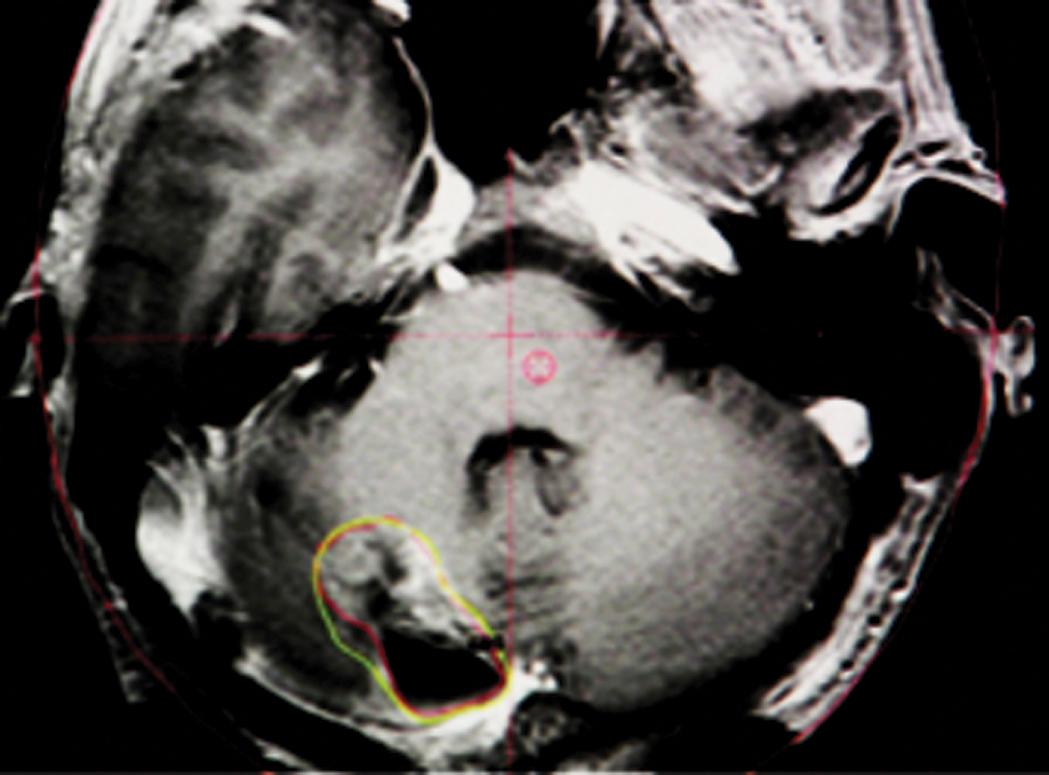 Fig. 14.4, Stereotactic radiosurgery plan for a right cerebellar postoperative cavity. The red line indicates the outlined surgical resection bed. The radiation field is delineated in yellow and encompasses the postoperative cavity.