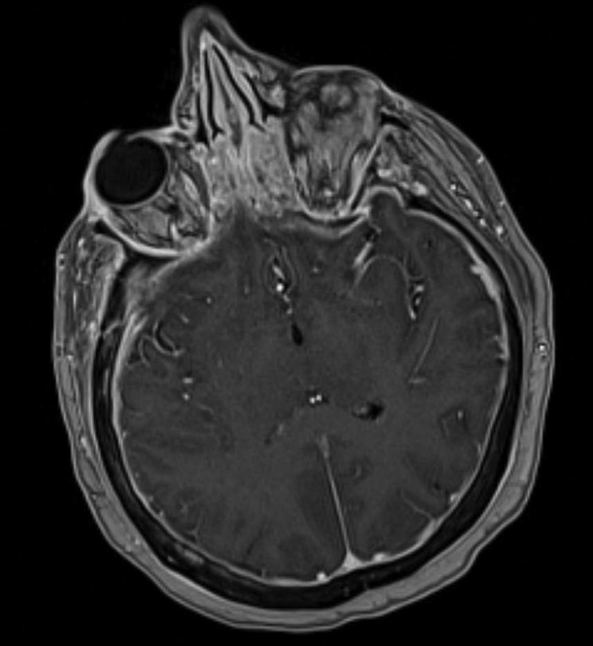 Fig. 14.5, Representative MRI of patient with leptomeningeal disease. There is flattening of the sulci, diffuse thickening of the dura, and extension into the orbit in the T1+contrast MRI.