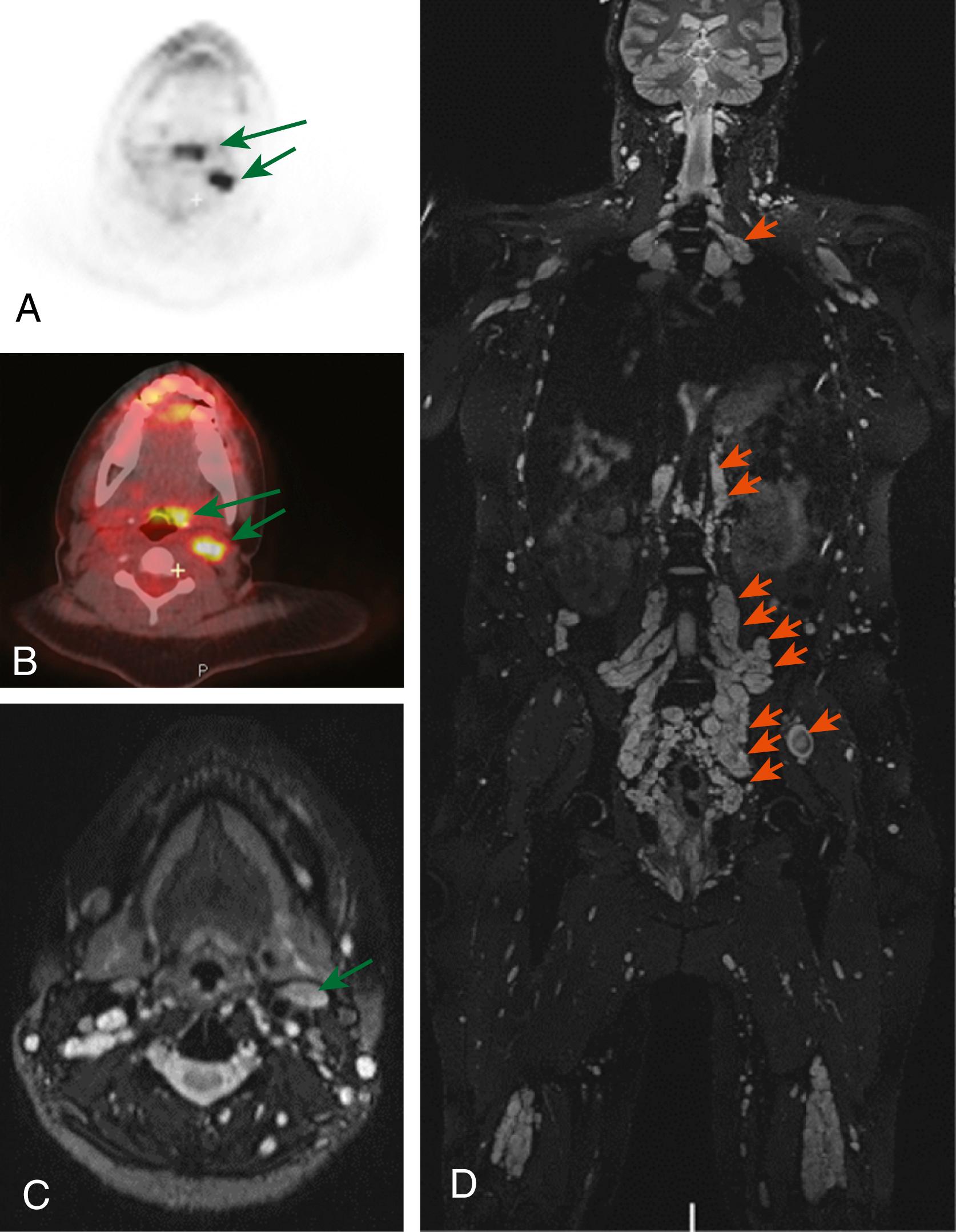 Fig. 16.1, Many plexiform neurofibromas seen on imaging in a patient with neurofibromatosis 1. (A, B) Fluorodeoxyglucose positron emission tomography (FDG-PET) showing two regions of elevated SUVmax (green arrows) ultimately determined to be pathologically consistent with neurofibroma. (C) Axial T2-weighted MRI showing that this lesion was nonspecific on MRI (green arrow) . (D) Whole body MRI with T2-weighted images showing multiple plexiform neurofibromas (orange arrows) involving bilateral brachial plexi, nerve roots at every level of the spinal cord, and in the distal nerves.