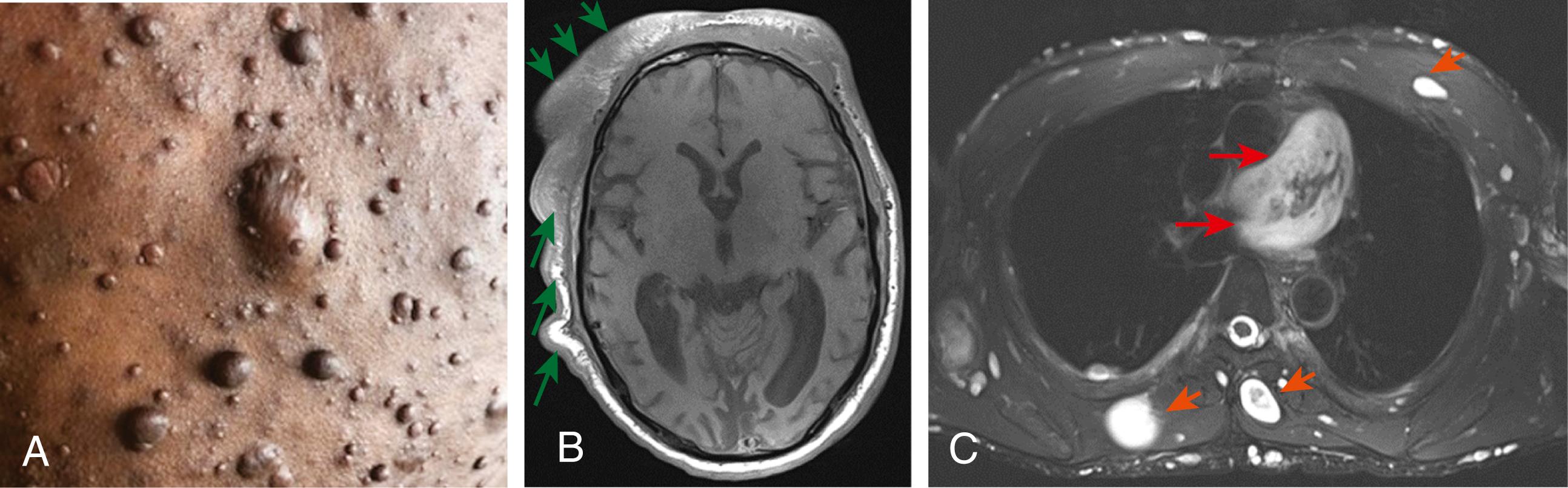 Fig. 16.2, Images of cutaneous and plexiform neurofibromas. (A) Picture of a patch of skin with multiple cutaneous neurofibromas and a diffuse superficial neurofibroma. (B) Shows axial T1-weighted images with a diffuse infiltrating neurofibroma of the scalp (green arrows) and (C) shows axial T2-weighted MRI images with a deep nodular (orange arrow) and plexiform neurofibromas (red arrows) .