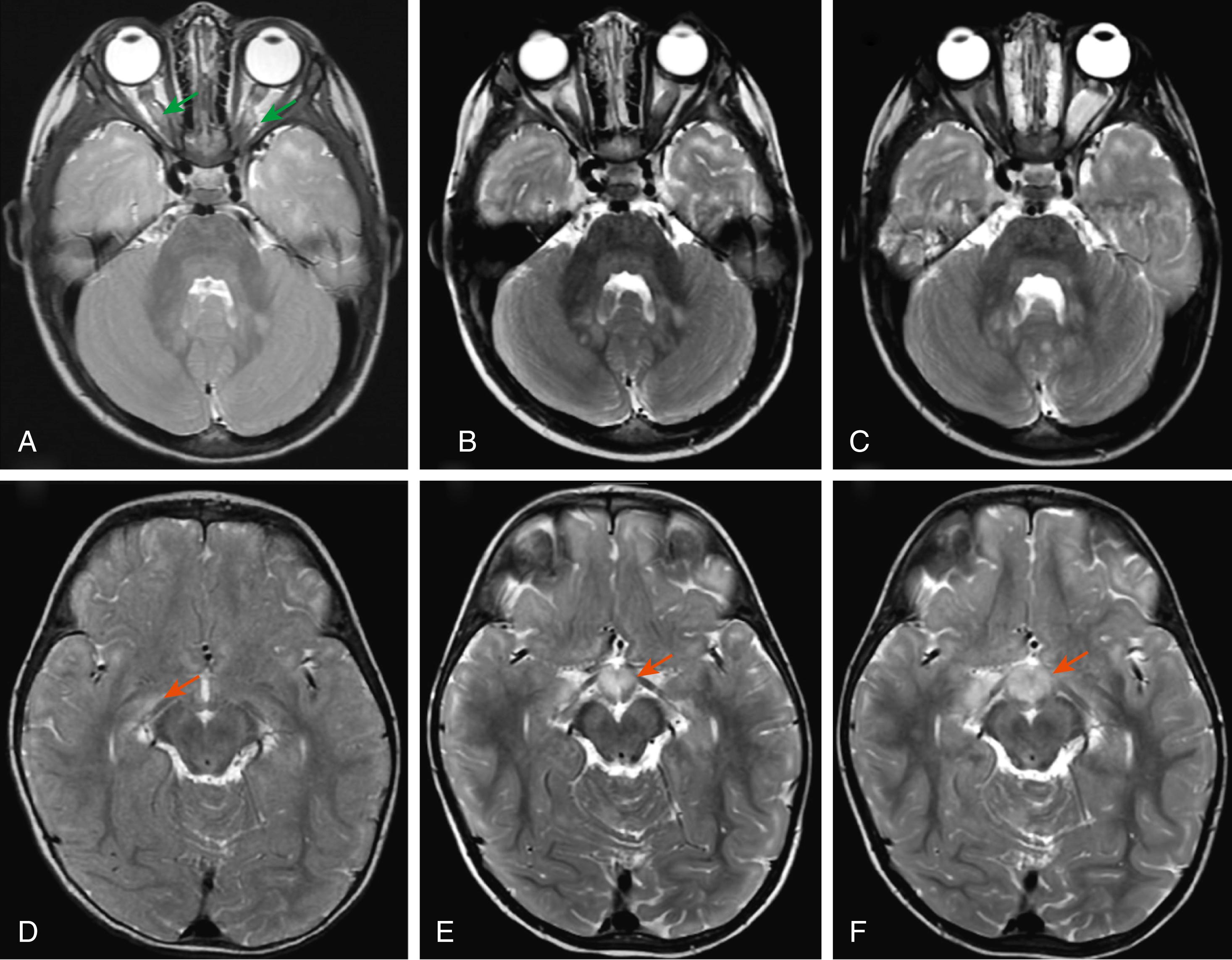 Fig. 16.3, Serial axial T2-weighted MRI sequences of the optic nerves (top row) and chiasm/hypothalamus (bottom row) in a young girl with NF1 showing progressive enlargement of the optic nerves (green arrows) , chiasm, and optic tracts (orange arrows) at diagnosis (A, D), 3 months (B, E) and 6 months (C, F).