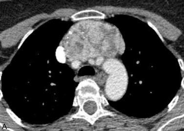 Fig. 7.1, CT scan of the chest with axial ( A ), coronal ( B ), and sagittal ( C ) views showing an intrathoracic substernal goiter, lying deep to the manubrium but superficial to the aorta. This was resected through a cervical incision with extension to partial sternotomy.