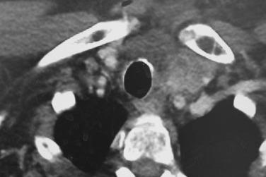 Fig. 7.2, Computed tomography (CT) scan of the chest showing lymph node extension from metastatic papillary thyroid carcinoma involving the anterior mediastinal nodes. The mass can be seen extending behind the left clavicular head and adjacent to the internal jugular vein. This was resected by cervical collar incision with partial sternotomy and trapdoor extension.