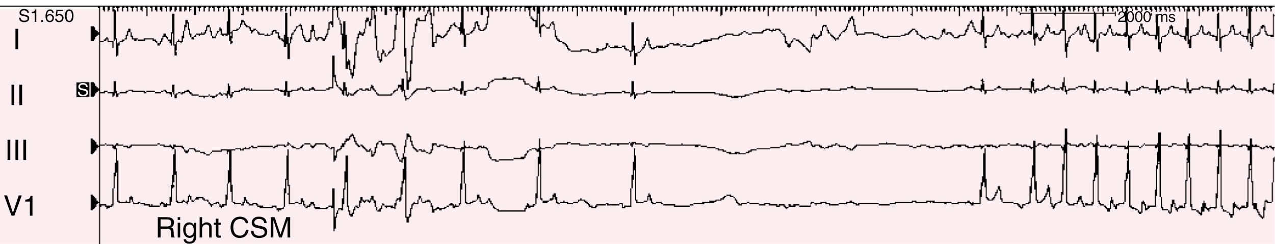 FIGURE 61.1, Right carotid sinus massage (CSM) produces sinus arrest and a 7.2-second pause in a patient with episodic dizziness.