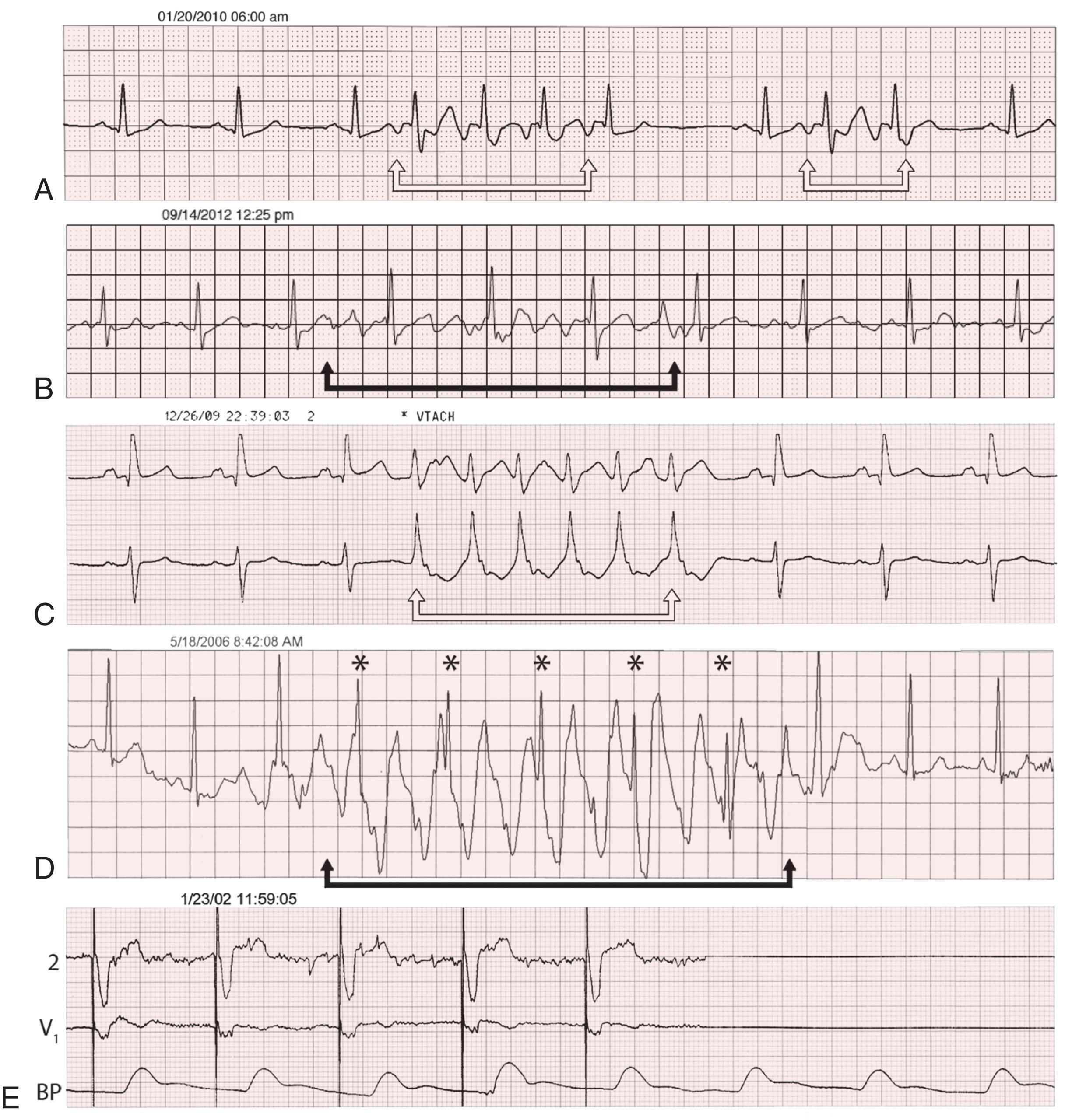 FIGURE 61.11, Electrocardiographic events and artifacts. A, Sinus rhythm punctuated by short episodes of atrial tachycardia with a more rapid rate (between the white arrows ). B, Pseudo–atrial arrhythmia. Sinus rhythm is present throughout (no variation in the R-R interval) despite the appearance of an artifact that mimics short episode of atrial flutter or fibrillation (between the black arrows ). C, Nonsustained VT (between the white arrows ) with wide rapid QRS complexes not preceded by a P wave and seen in two monitor leads. D, Pseudo-VT. Despite the appearance of VT (between the black arrows ), sinus rhythm is present throughout (including complexes indicated by asterisks ). E, Pseudo–pacemaker failure. After the first five paced complexes, the ECG is flat in both monitor leads, thus suggesting failure of pacemaker output; however, the pulse contour on the blood pressure (BP) tracing indicates that the heart is still contracting and the pacemaker is still working whereas the ECG monitor is not.