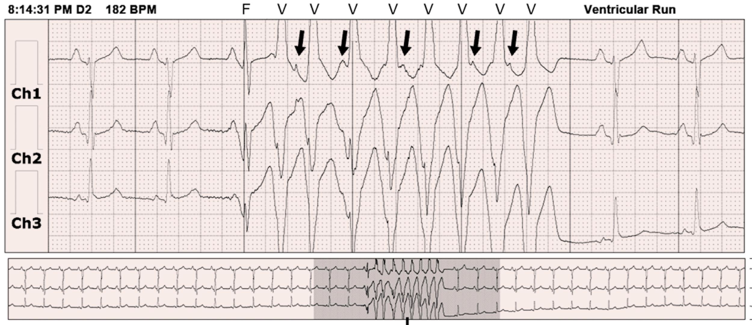 FIGURE 61.12, Long-term electrocardiographic recording in a patient with palpitations. A three-channel monitor shows sinus rhythm followed by nine wide QRS complexes of VT (labeled “V”); the complex that precedes these is a fusion between the normal complex and wide (“F”). Arrows indicate retrograde P waves during tachycardia. The presence of fewer P waves than QRS complexes and a fusion complex at the outset confirm the diagnosis of VT (which correlated with the patient’s palpitations).