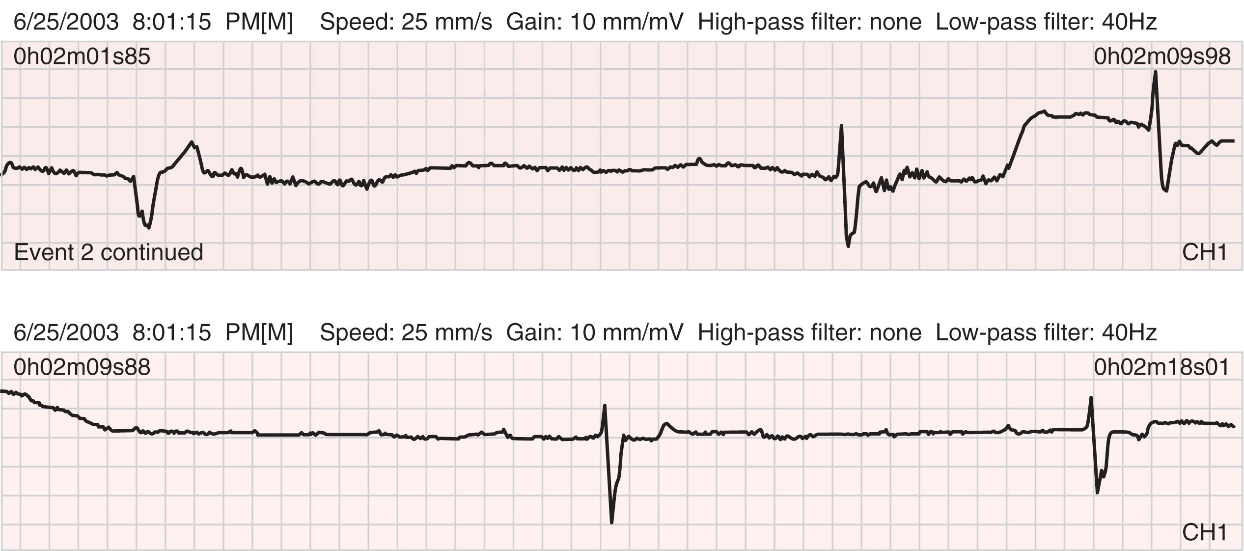 FIGURE 61.13, Continuous electrocardiographic recording from a patient-activated event monitor during an episode of lightheadedness. Sinus rhythm at 75 beats/min with sudden AV block is present with pauses of longer than 4 seconds, and in the bottom strip there is an effective heart rate of approximately 8 beats/min.