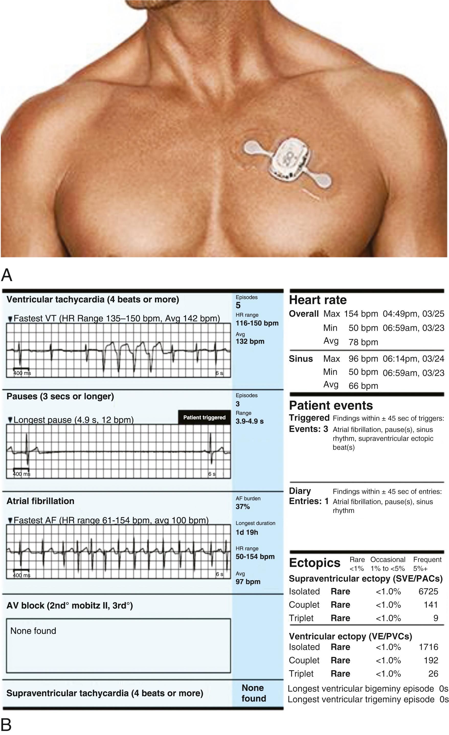 EFIGURE 61.1, A, Adhesive electrocardiographic patch that allows for long-term continuous recording of the ECG. B, Summary page illustrating three patient-triggered events: wide-complex rhythm during atrial fibrillation (AF), a 4.9-second pause with termination of a paroxysm of AF, and AF with rapid ventricular response.