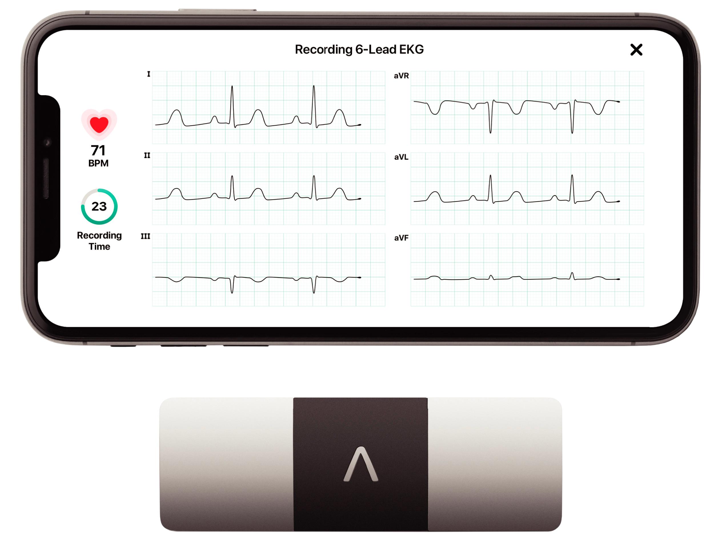 EFIGURE 61.2, Real-time monitoring of the ECG. Finger contact with the two electrodes on the front of the device while the electrode on the back of the device (not shown) rests on the left leg of the patient activates multi-lead ECG recording that is transmitted to the smartphone (top).