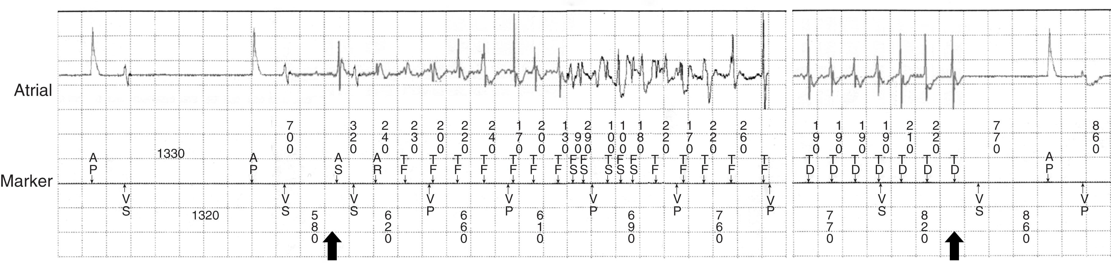 FIGURE 61.14, Recordings from a pacemaker log showing an episode of atrial fibrillation (AF) at its onset (left arrow) and termination (right arrow) , more than four days later. Two atrial paced complexes (AP) are followed by an episode of AF characterized by rapid erratic deflections. When the episode ends, atrial pacing resumes. The patient was unaware of the episode, but when discovered at a routine office follow-up visit, this information prompted initiation of anticoagulation in light of an elevated stroke risk and newly discovered AF.