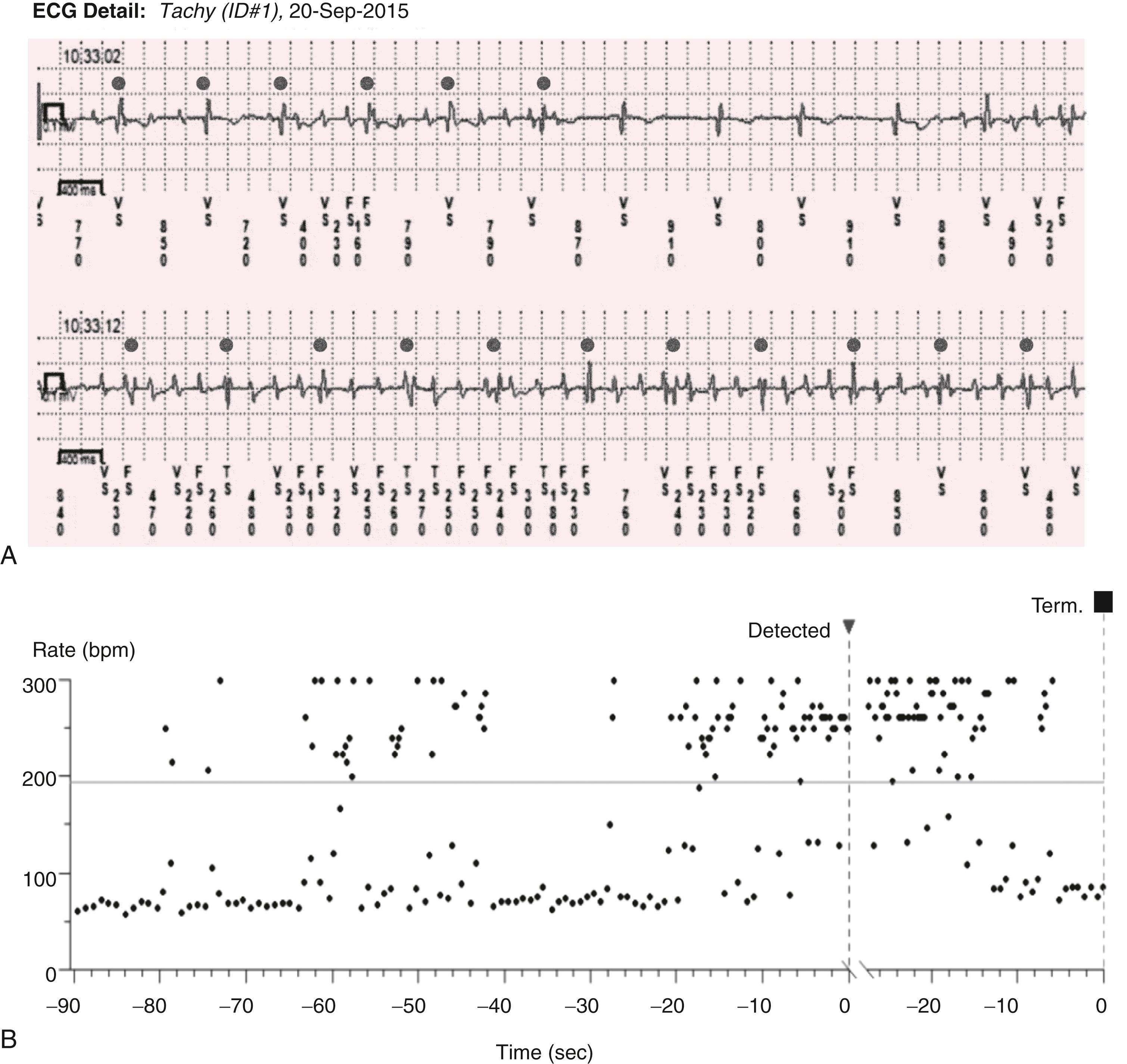 EFIGURE 61.3, Implantable loop recorders (ILRs) are implanted subcutaneously and can continuously record a single-lead ECG for up to 36 months. A, Rhythms recorded by an ILR and interrogated remotely by telephone in a patient with Parkinson disease. Artifact from the movement disorder is interpreted as tachycardia; the dots identify the QRS complexes. B, A time-series plot of the detected rates at the time of the artifact.