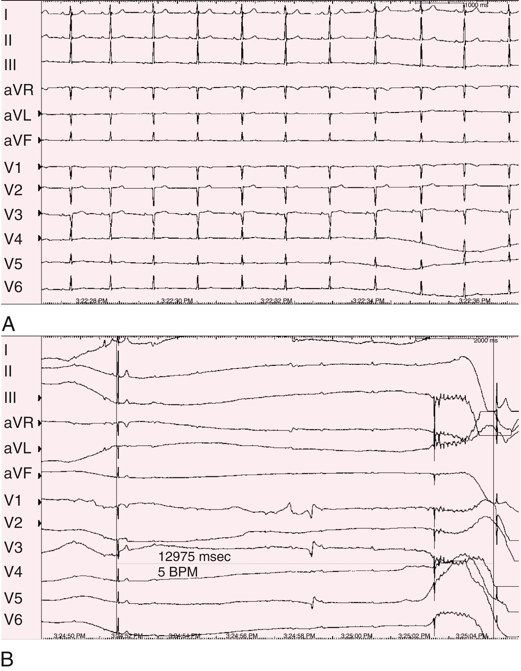 EFIGURE 61.6, Head-up tilt-table response in a patient with syncope in the absence of structural heart disease. A, 12-Lead ECG immediately before syncope. B, Sinus bradycardia and atrioventricular block produce hypotension and syncope 15 minutes after head-up tilt-table test.