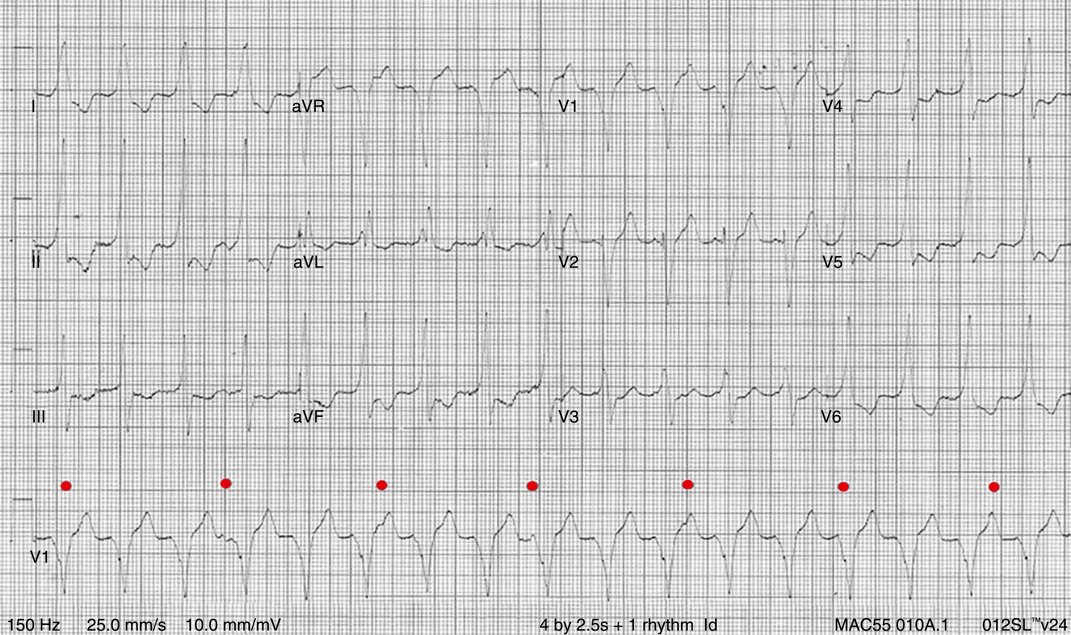 FIGURE 61.2, Wide complex tachycardia with AV dissociation establishing the diagnosis of ventricular tachycardia. P waves are dissociated from the QRS complexes and are indicated by the red dots; the sinus rate is approximately 40 beats/min.