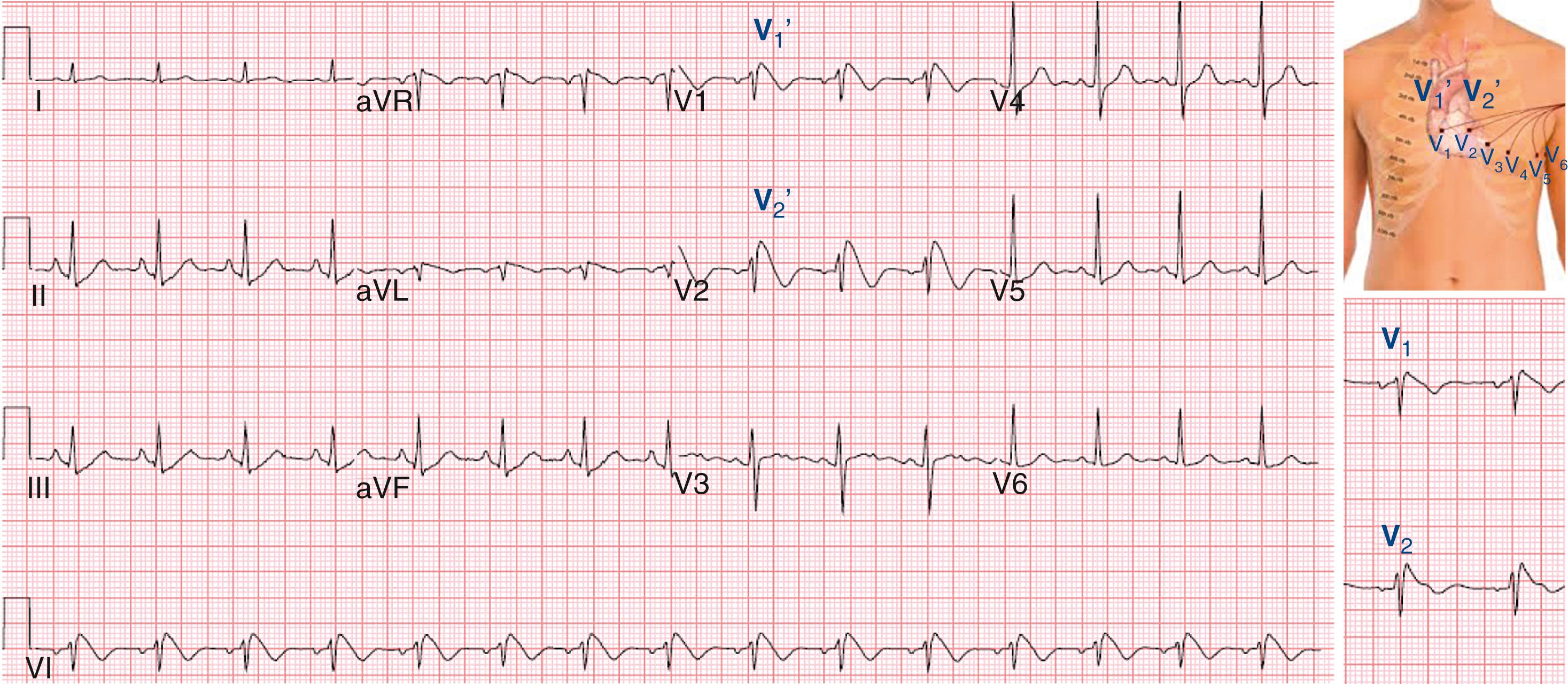 FIGURE 61.3, 12-Lead electrocardiogram from a patient with Brugada syndrome with V 1 ′ and V 2 ′ recorded in the second intercostal space, as shown on the torso. Inset, Appearance of leads V1 and V2 in the standard positions in this patient.