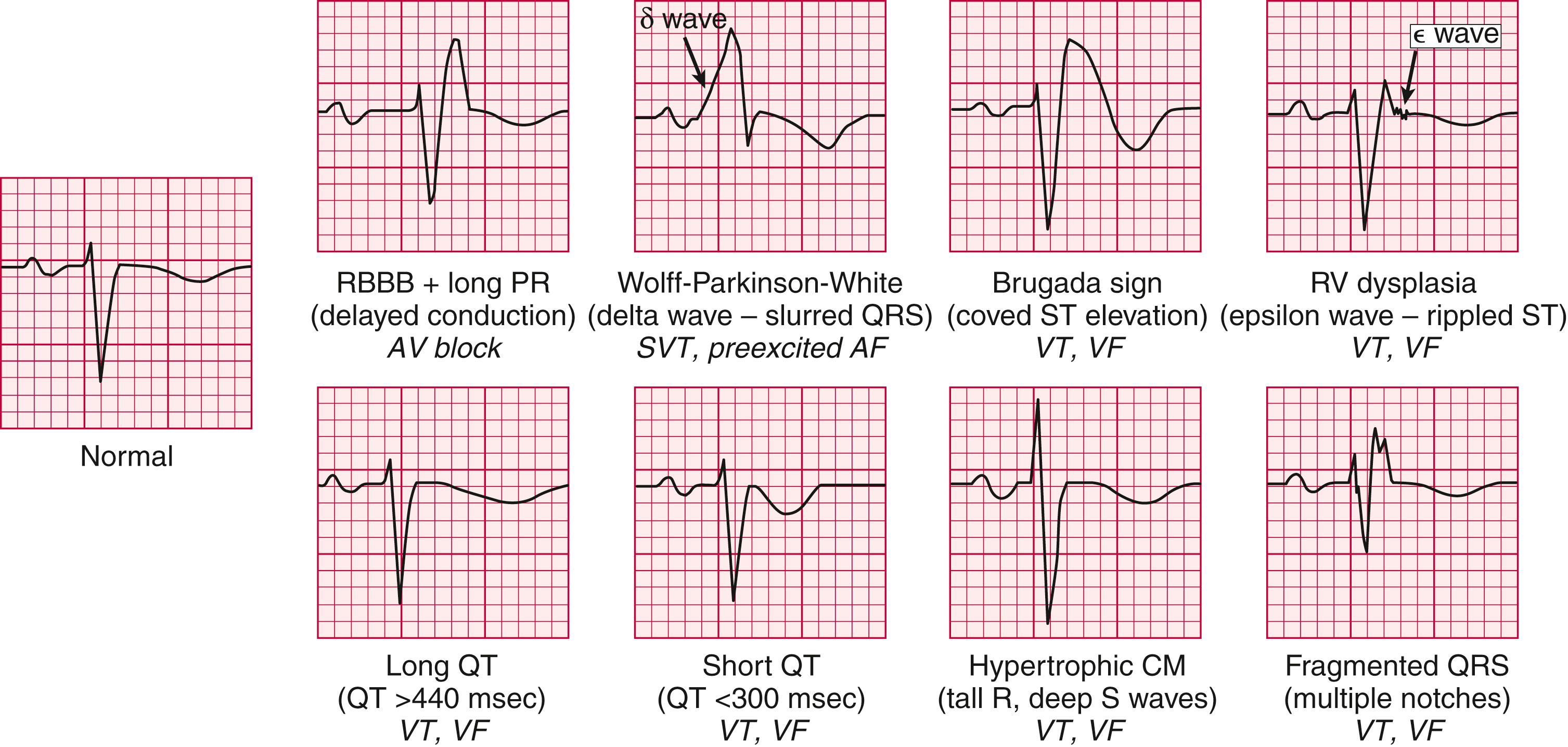 FIGURE 61.4, Resting QRS abnormalities that suggest potential for arrhythmia. Lead V1 is shown in each example; a normal complex is presented at left for reference. CM, Cardiomyopathy; RBBB, right bundle branch block; RV, right ventricular.