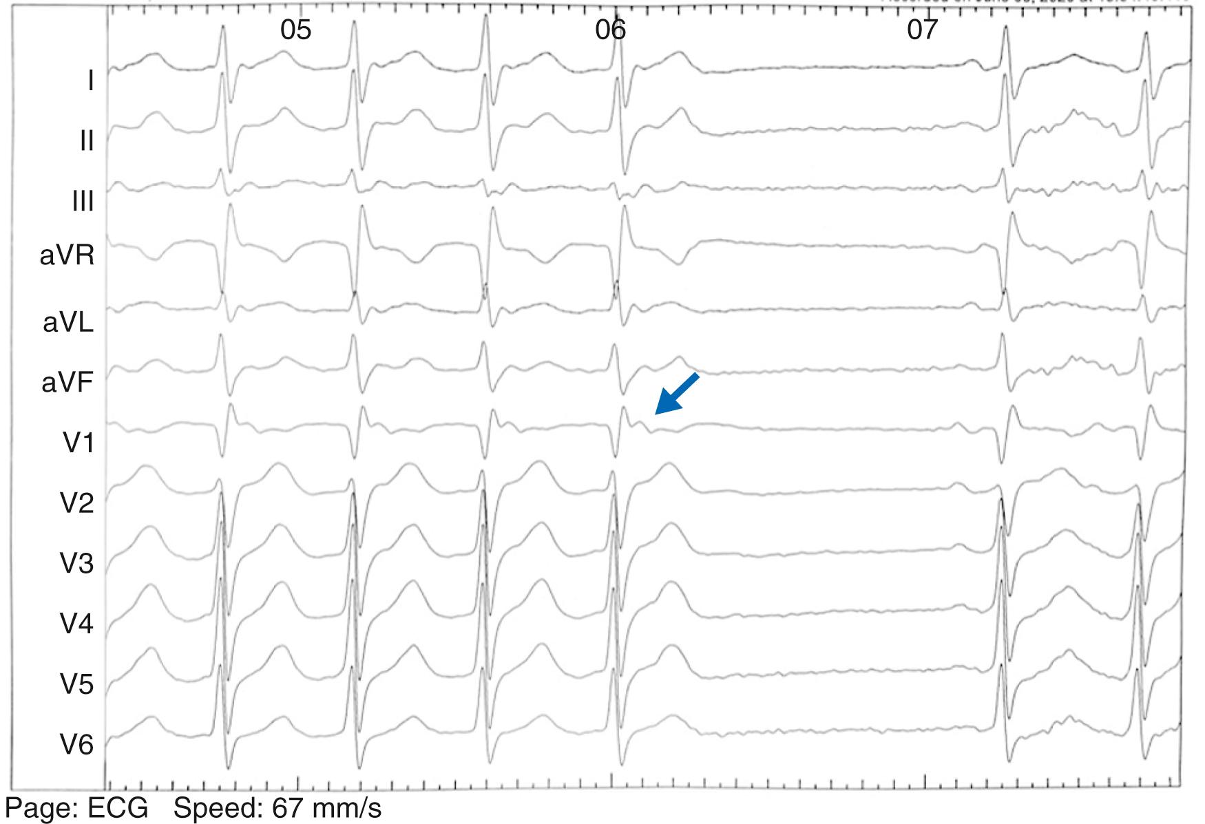 FIGURE 61.6, Supraventricular tachycardia, typical AV reentry tachycardia terminated by 6 mg of IV adenosine. The tachycardia terminates with a retrograde P wave (arrow) . After the pause, the temporal relationship of the P wave to the QRS changes indicating conversion to sinus rhythm.