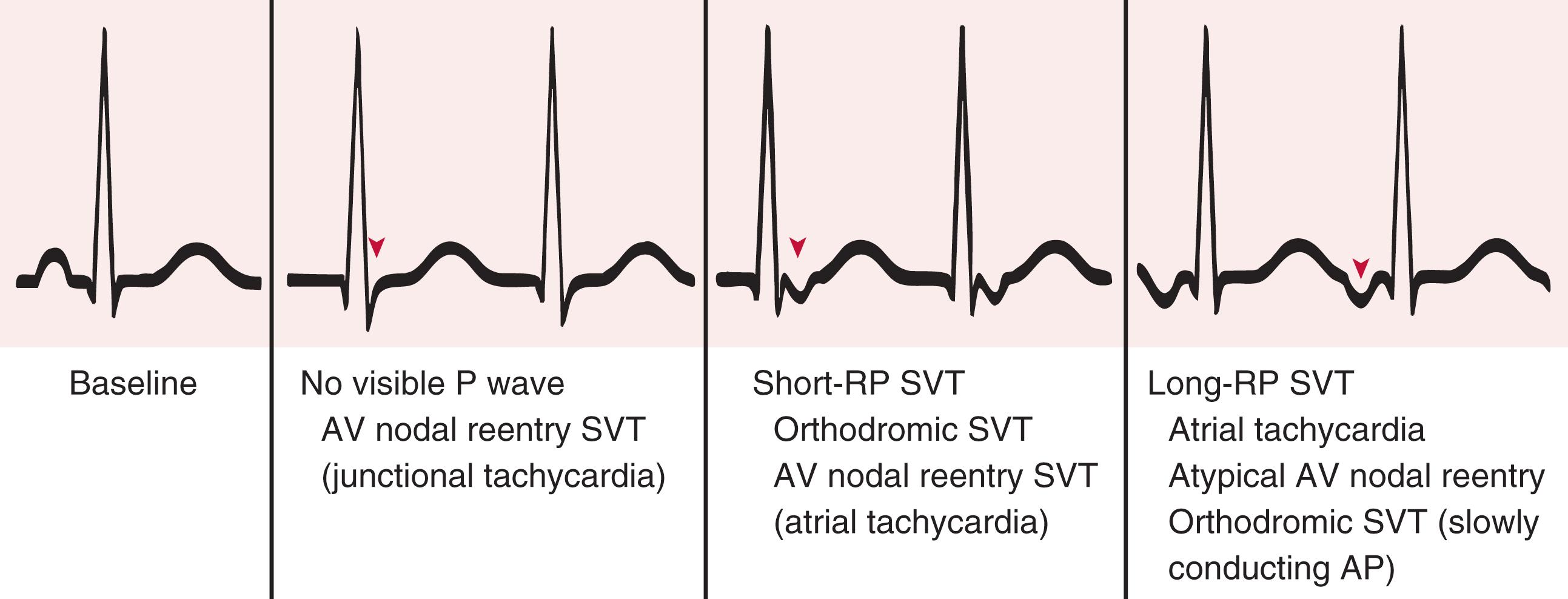 FIGURE 61.7, Differential diagnosis of types of supraventricular tachycardia based on timing of atrial activity (RP and PR intervals). Left, Normal beat. The types of tachycardia are listed below the representative electrocardiographic patterns that they can produce, as categorized by P wave position relative to the QRS complex. An arrowhead shows the location of the P wave in each example. Diagnoses in parentheses are rare causes of the noted findings. AP, Accessory pathway.