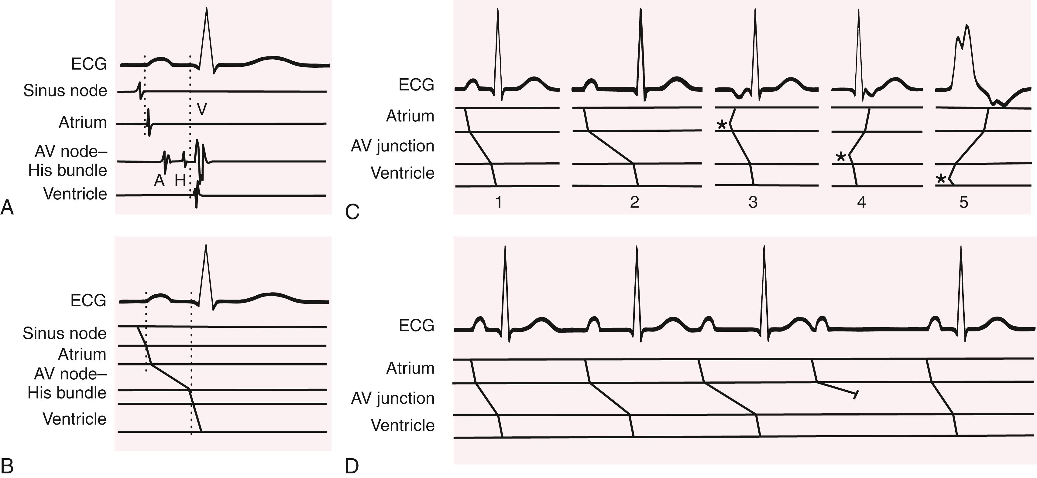 FIGURE 61.8, Intracardiac signals and ladder diagrams. A, A single beat is shown with accompanying intracardiac signals from the sinus node, right atrium, atrioventricular (AV) nodal and His bundle regions, and right ventricle. B, The same beat is shown with the accompanying ladder diagram below. Cardiac regions have been divided into tiers separated by horizontal lines. Vertical dotted lines denote onset of the P wave and QRS complexes. The relatively steep lines indicate rapid conduction through the atrium, His bundle, and ventricular muscle and more gently sloping lines the slower conduction in the sinus and AV nodes. C, Different situations with accompanying explanatory ladder diagrams. Beat 1 is normal, as in B ; beat 2 shows first-degree AV delay, with the more gradual slope than normal in the AV nodal tier signifying very slow conduction in this region. In beat 3 an atrial premature complex is shown (starting in the atrial tier at the asterisk ) and is producing an inverted P wave on the ECG. In beat 4 an ectopic impulse arises in the His bundle (asterisk) and propagates to the ventricle, as well as retrogradely through the AV node to the atrium. In beat 5 a ventricular ectopic complex (asterisk) conducts retrogradely through the His bundle and AV node and eventually to the atrium. D, Wenckebach AV cycle (type I second-degree block). As the PR interval progressively increases from left to right in the figure, the slope of the line in the AV nodal region flattens until it fails to propagate at all after the fourth P wave (small line perpendicular to the sloping AV nodal conduction line), after which the cycle repeats. A, Atrial recording; H, His recording; V, ventricular recording.