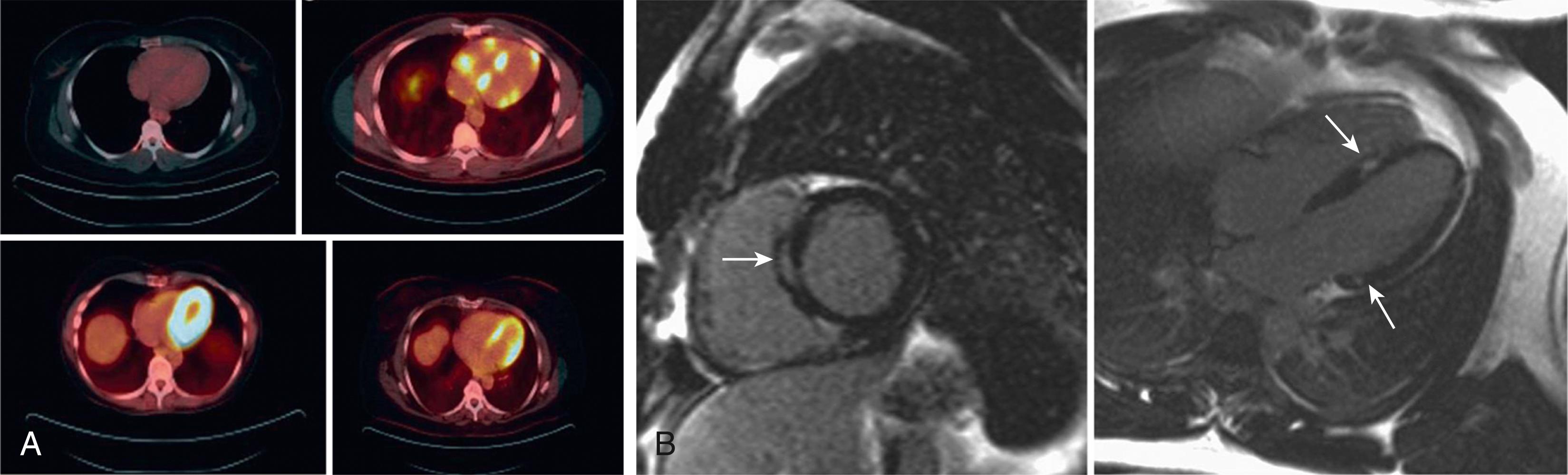 FIGURE 61.9, Sarcoidosis A, Four images show the pattern of 18F-fluorodeoxyglucose uptake on positron emission tomography (PET) scan. B, Two cardiac magnetic resonance images show evidence of delayed gadolinium enhancement in the midwall of the left ventricle (arrows) .