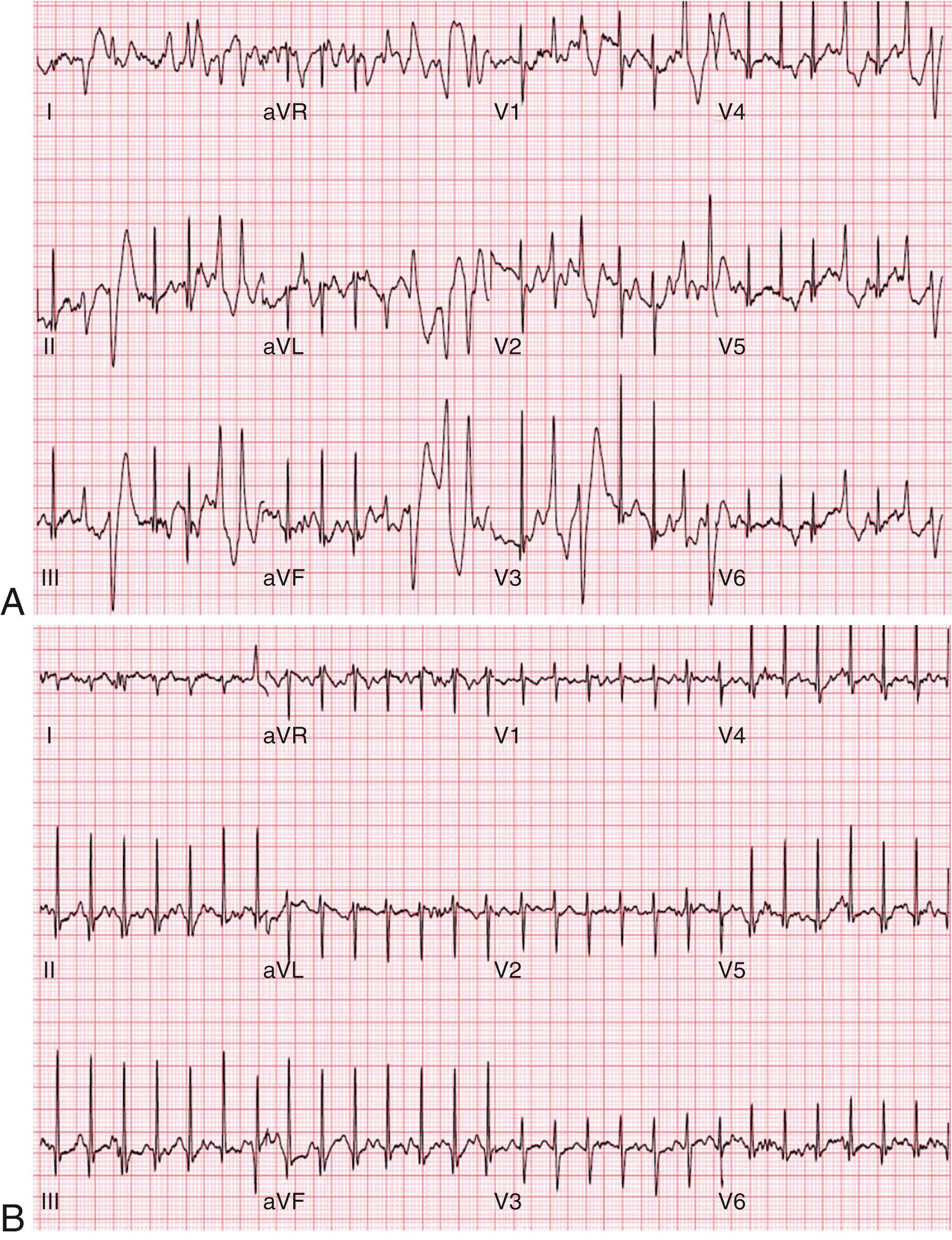 FIGURE 61.10, Exercise-induced polymorphic premature ventricular complexes and ventricular tachycardia (VT) in a young woman with dizziness; palpitations caused by a ryanodine receptor (RyR2) mutation producing catecholaminergic polymorphic VT (CPVT). A, ECG at peak exercise before treatment. B, ECG while receiving treatment with nadolol and flecainide.