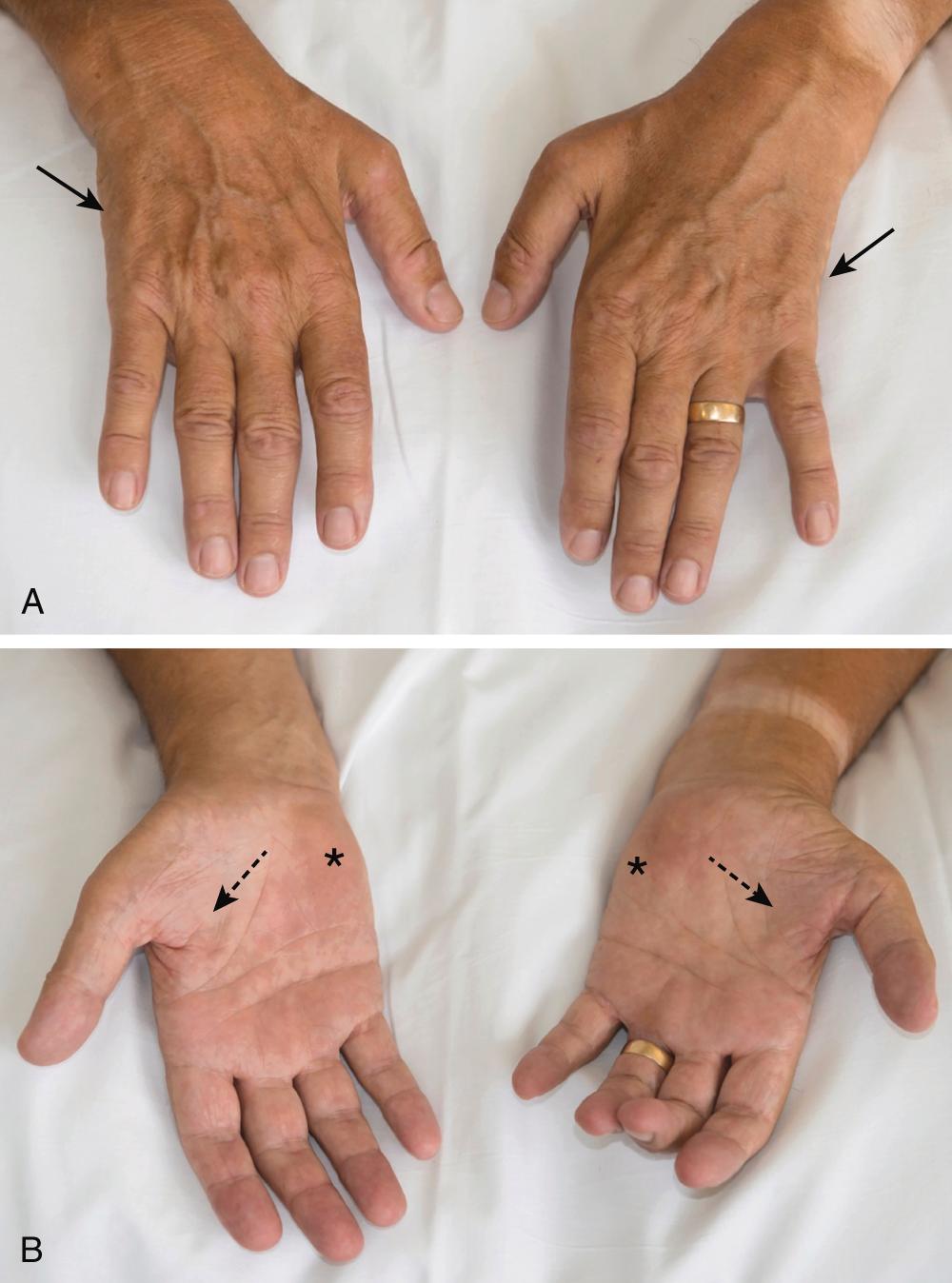 E-FIGURE 366-2, Charcot-Marie-Tooth disease.