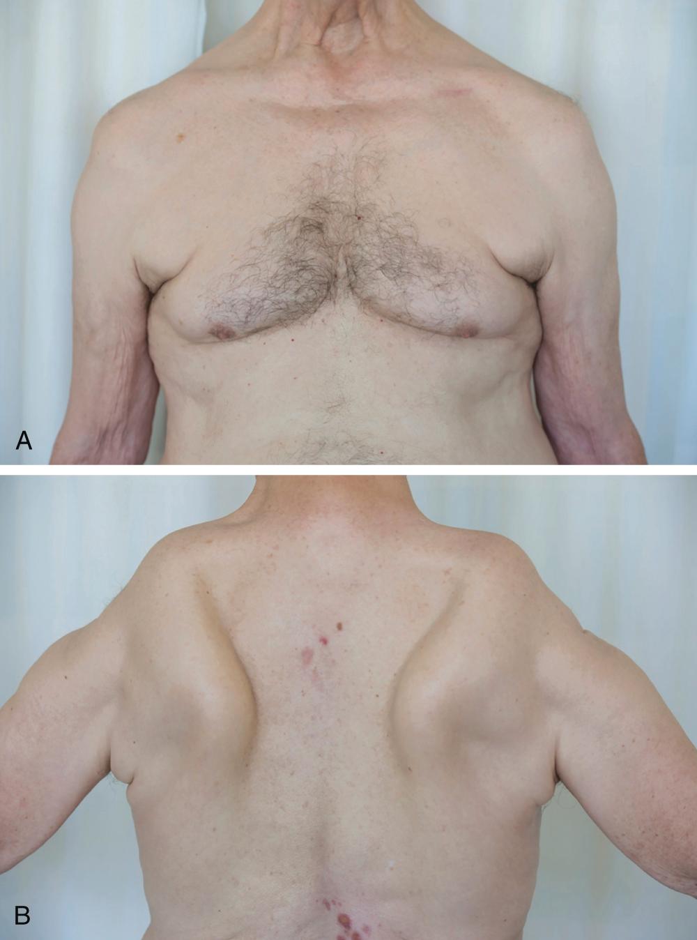 E-FIGURE 366-4, Facioscapulohumeral dystrophy.