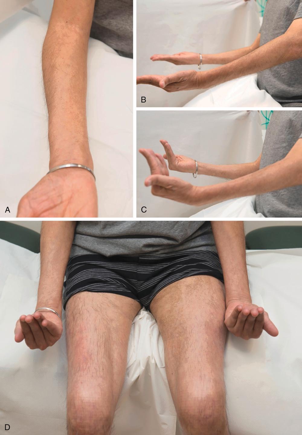 E-FIGURE 366-5, Inclusion body myositis.