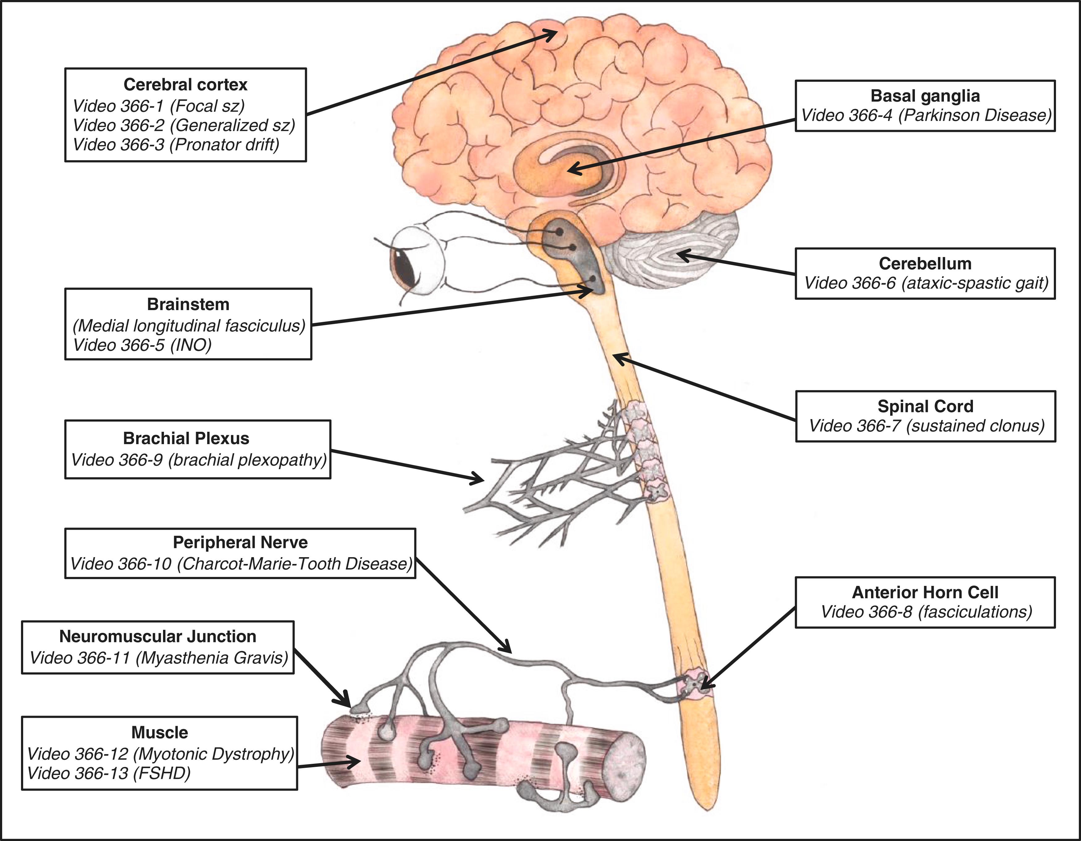 E-FIGURE 366-6, Videos illustrating neurologic findings. FSHD = facioscapulohumeral muscular dystrophy; sz = seizure.