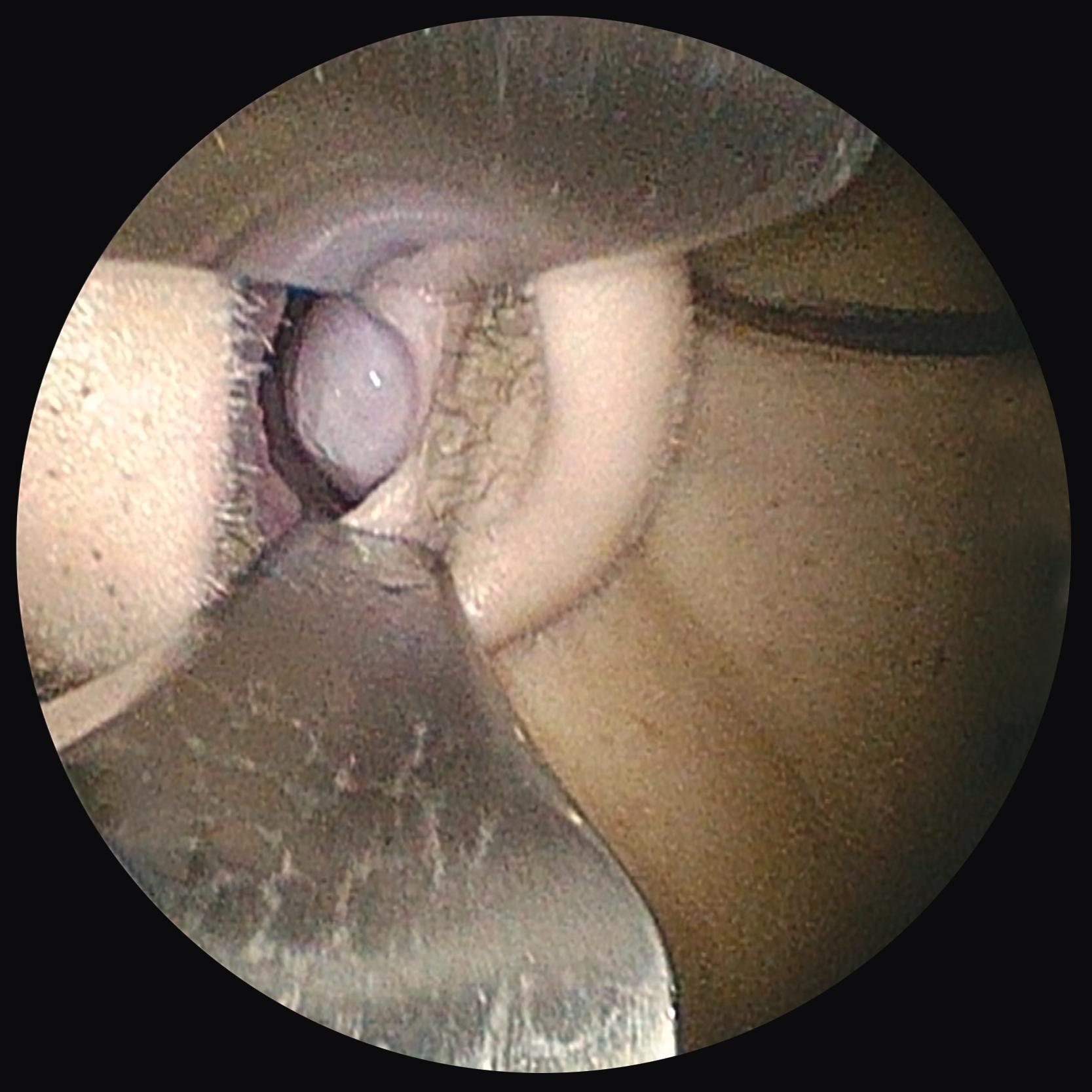 FIGURE 394-2, Examination of the left nasal cavity using a nasal speculum demonstrates an edematous, pale inferior turbinate consistent with allergic rhinitis.