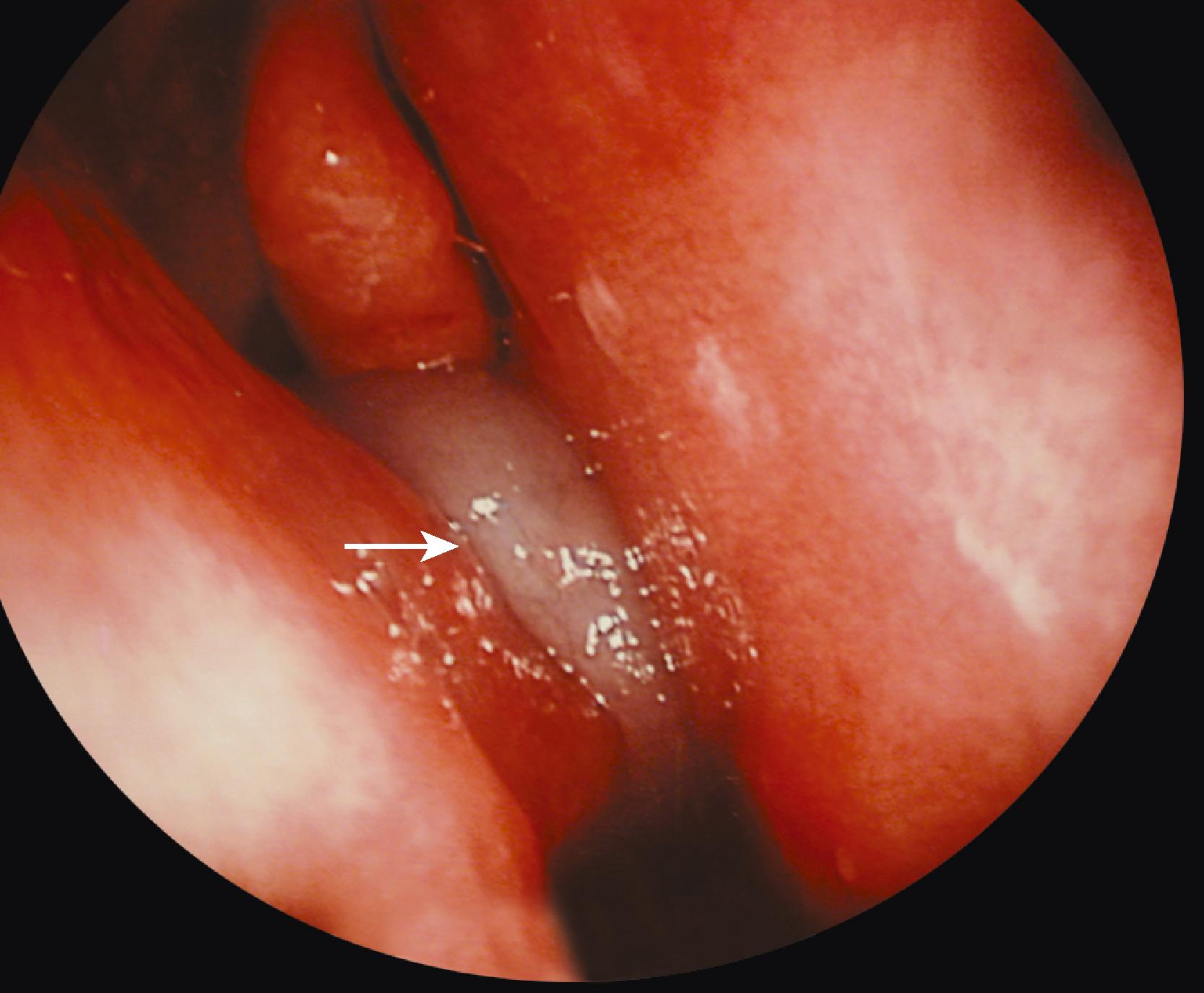 FIGURE 394-3, Nasal polyp in the right nasal cavity.