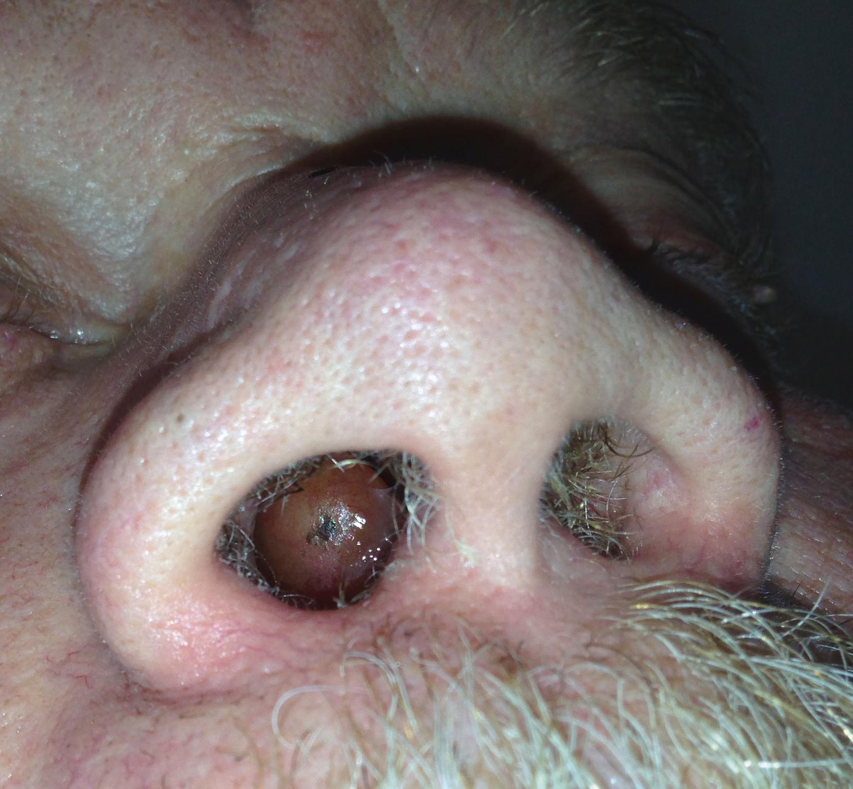 FIGURE 394-4, Nasal polyp clearly visible on physical examination.