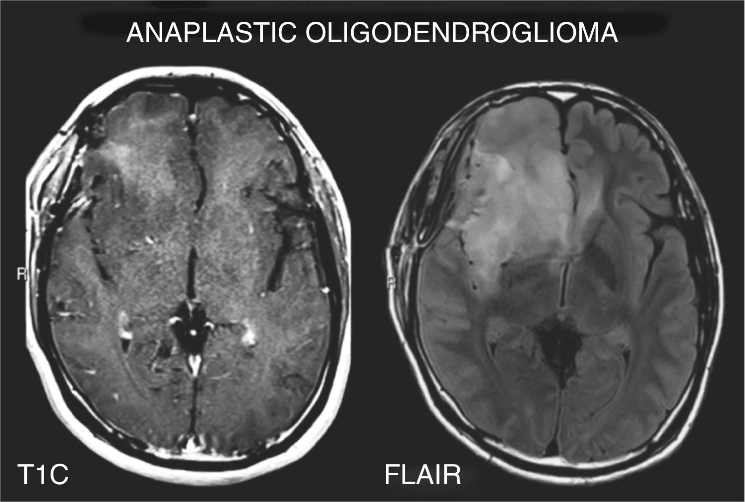 Fig. 12.2, Conventional MRI of an anaplastic oligodendroglioma. This patient was initially diagnosed with a grade II oligodendroglioma with an extensive T2/FLAIR hyperintense volume. Over time, faint gadolinium enhancement developed on the T1-weighted images (see in the right frontal lobe), which was confirmed to be grade III oligodendroglioma on subsequent resection. FLAIR , Fluid attenuated inversion recovery.