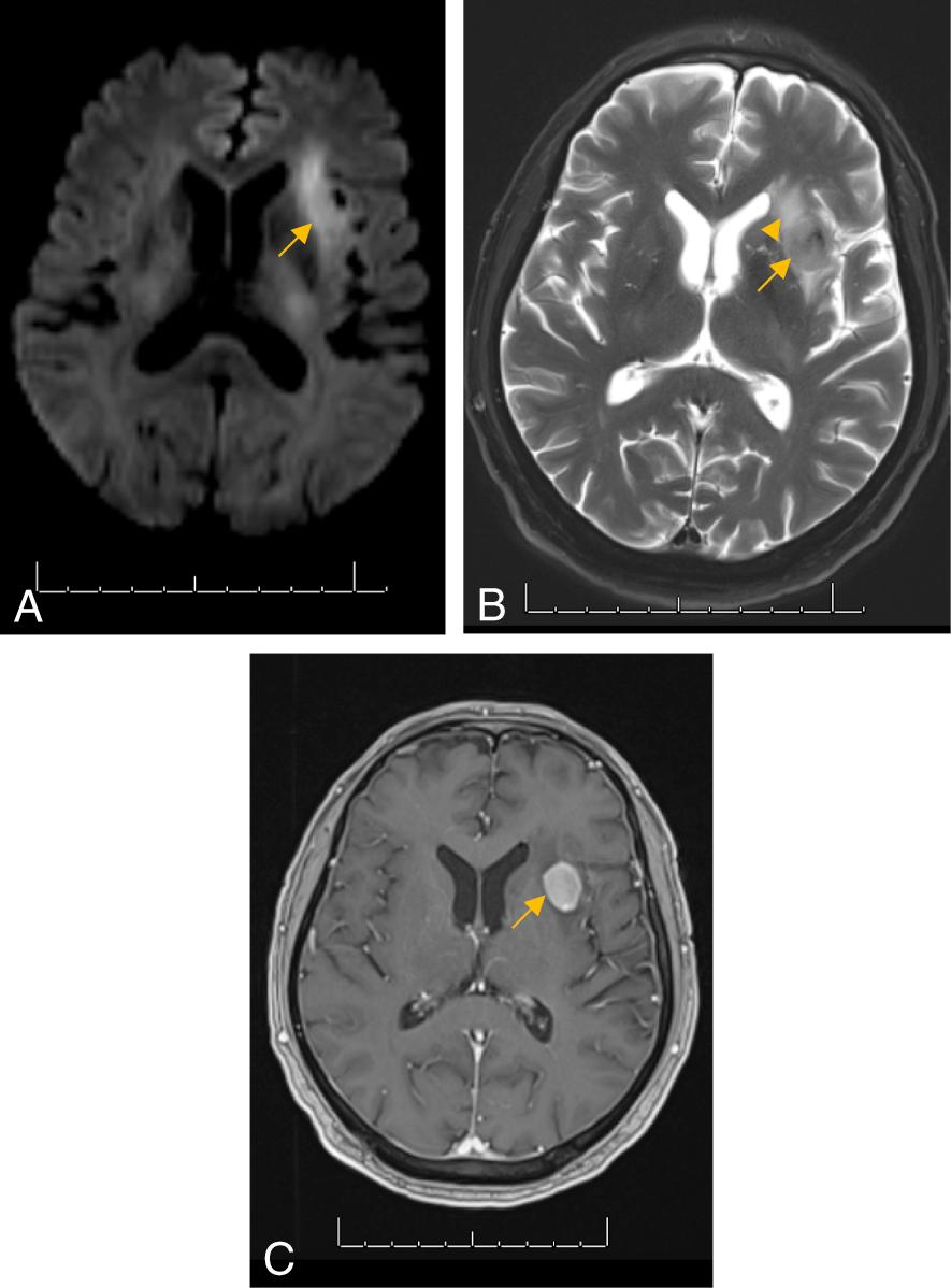 Fig. 13.1, MRI of the brain including (A) axial diffusion-weighted imaging showing an area of restricted diffusion in the left insular cortex (arrow), (B) axial T2-weighted imaging showing a central round mass lesion (arrow) with surrounding cerebral edema (arrowhead), and (C) axial T1-weighted homogeneously gadolinium-enhanced lesion (arrow) measuring 1.4 × 1.8 cm 2 .